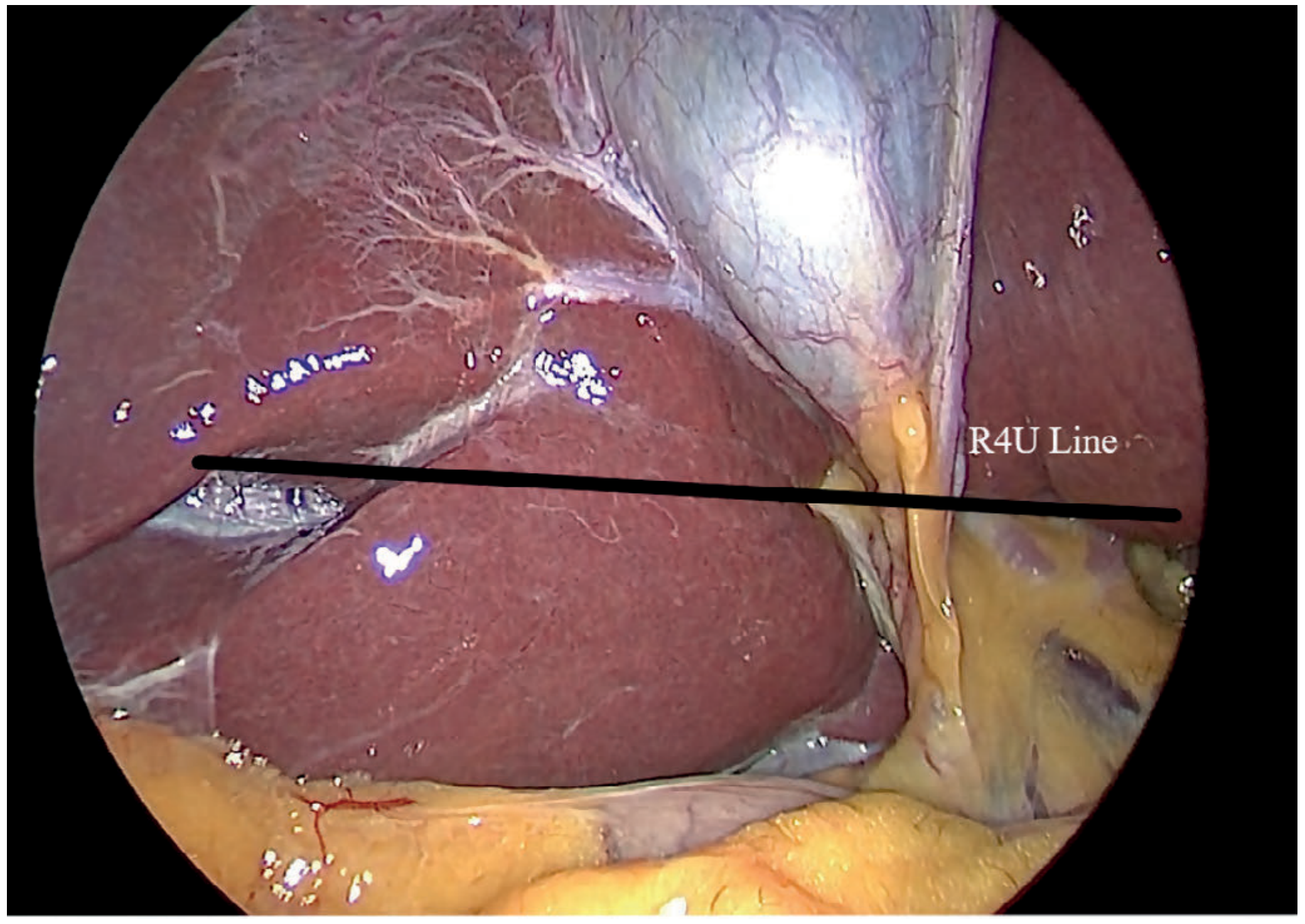 R4U Line - Bailey & Love Figure 71.3 - the black line extends from Rouviere's sulcus across segment IV to the umbilical fissure, marking the safe zone boundary
