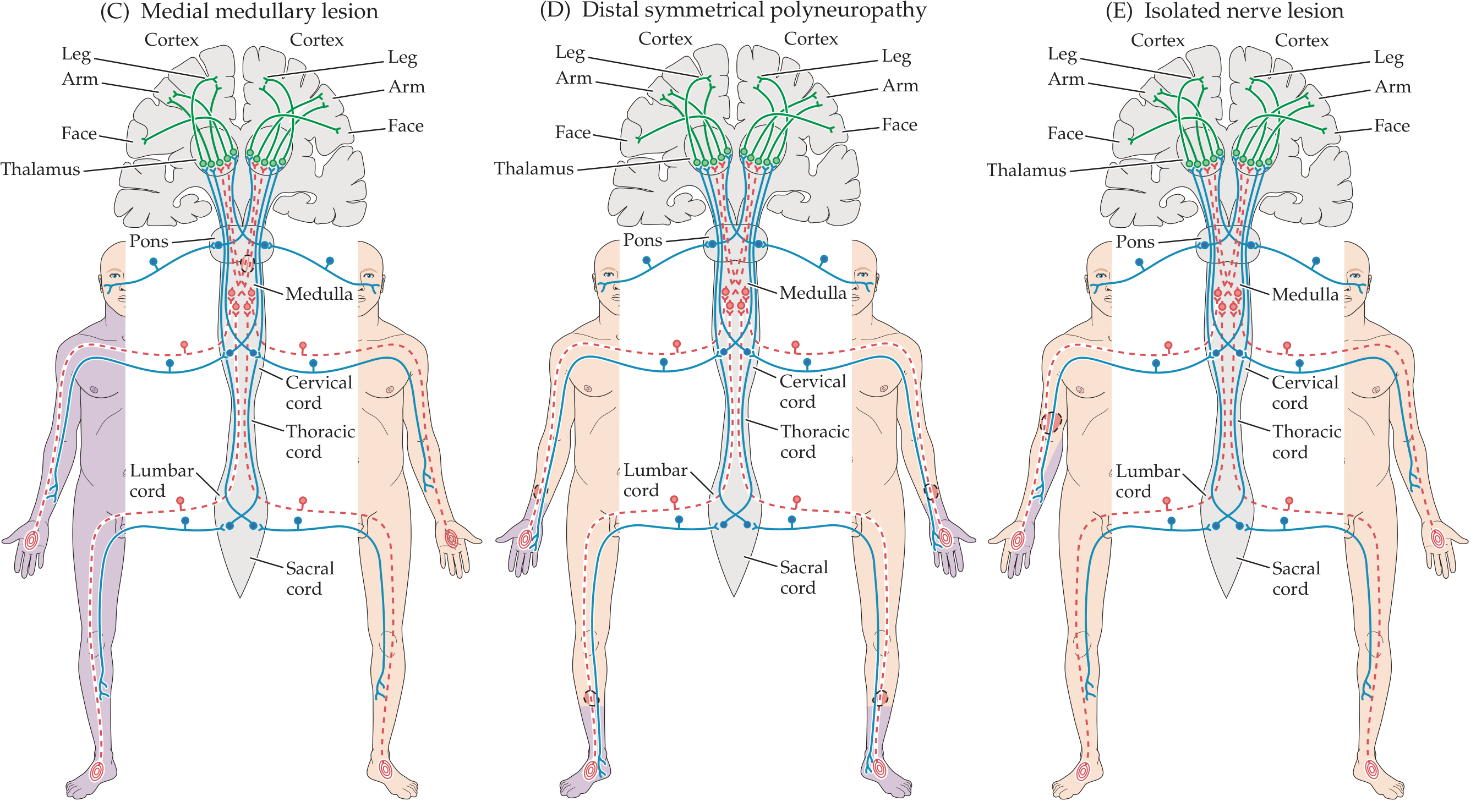 Patterns of sensory loss by lesion location - cortical/thalamic, lateral medullary, and peripheral nerve lesions