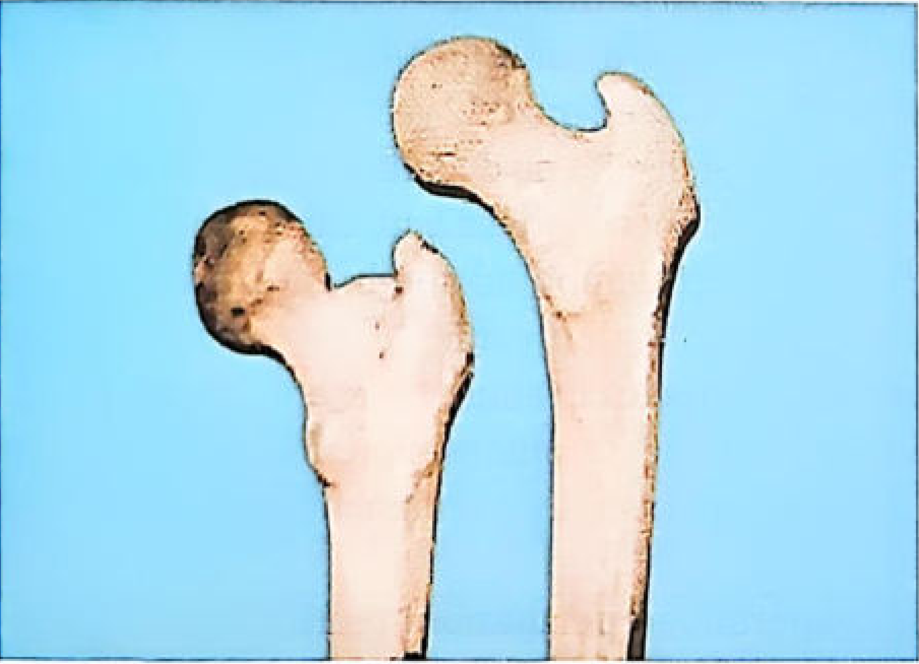 Male (right) and female (left) femurs - the neck angle is more obtuse in the male