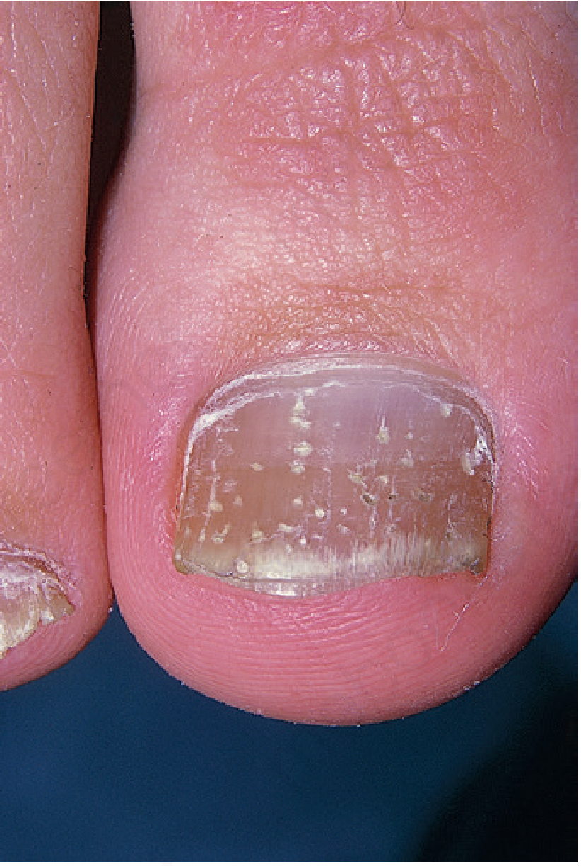 Psoriasis Nail Pitting
