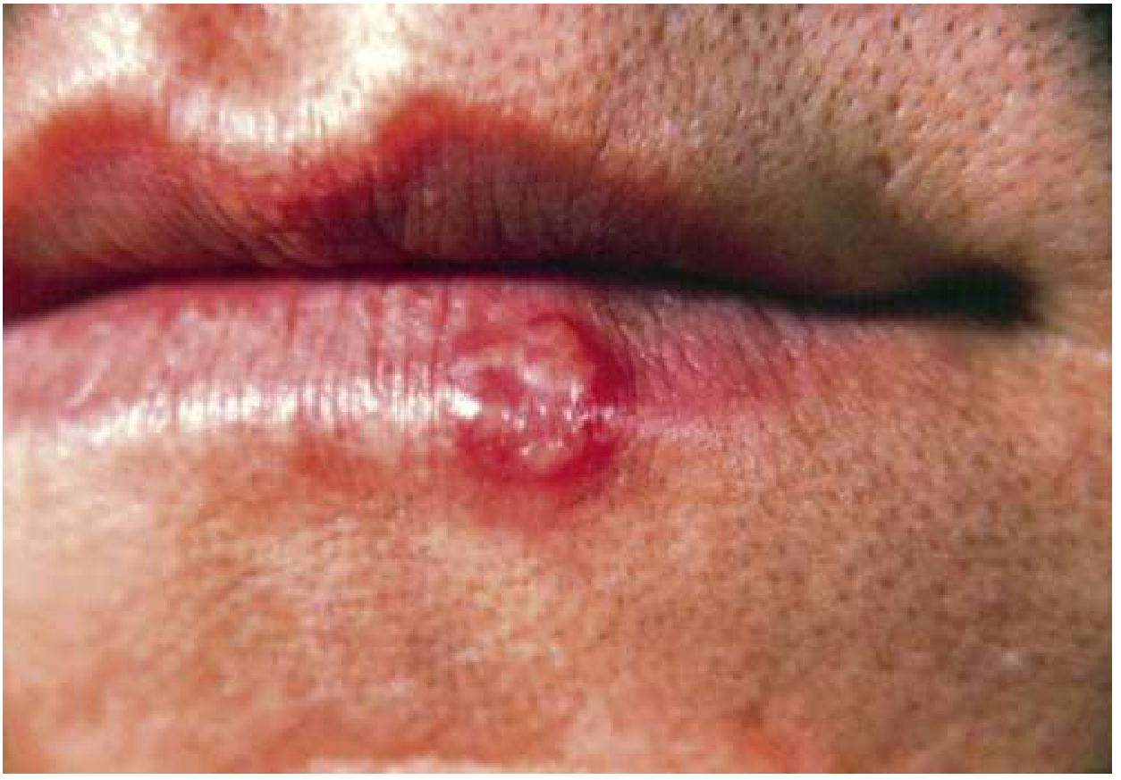 Herpes Labialis - vesicle at vermilion border of lip