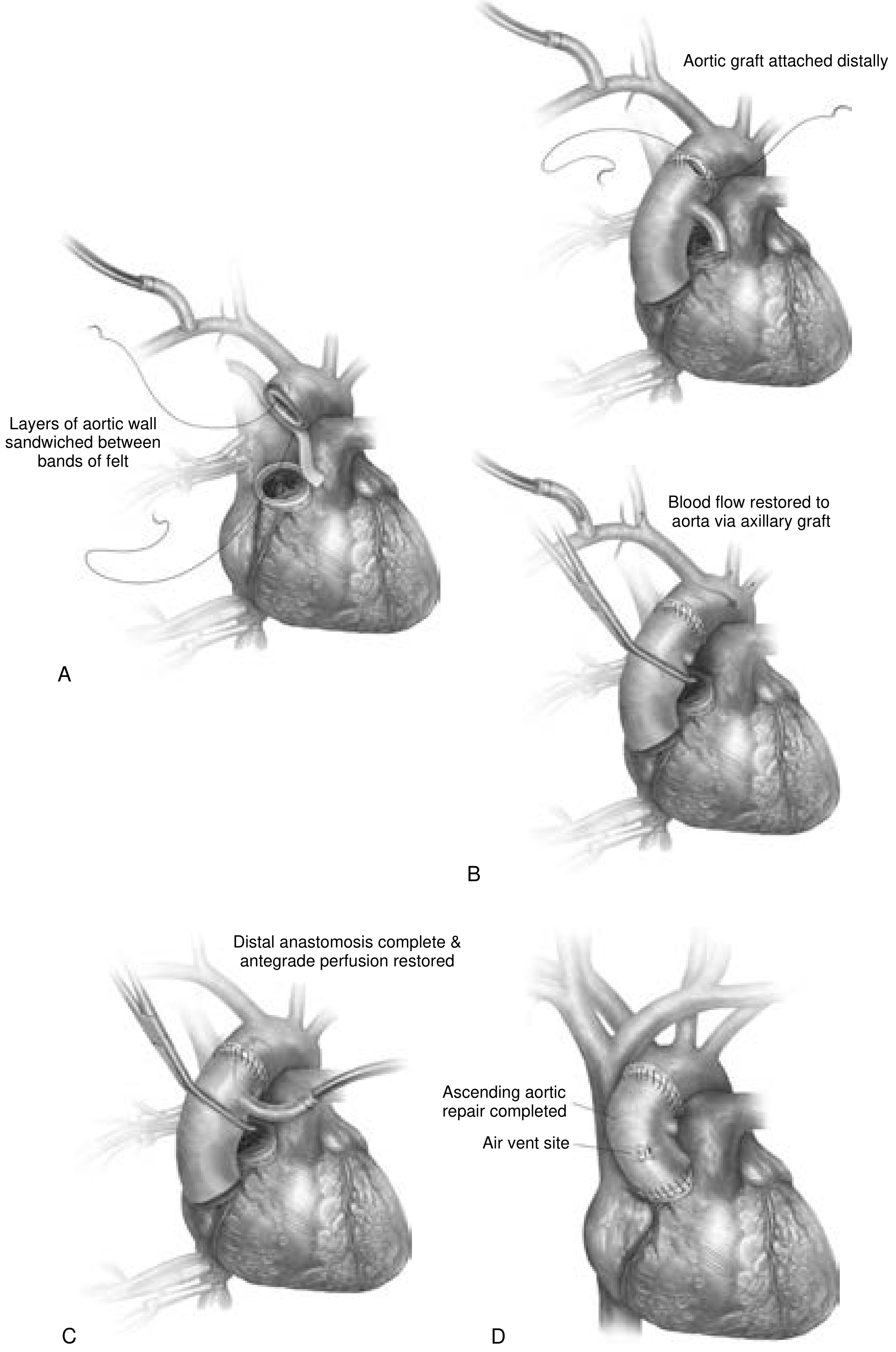 Type A aortic dissection repair: (A) aortic layers sandwiched between Teflon felt, (B) distal anastomosis complete + axillary graft perfusion, (C) antegrade perfusion via side-arm, (D) completed repair with valve resuspended