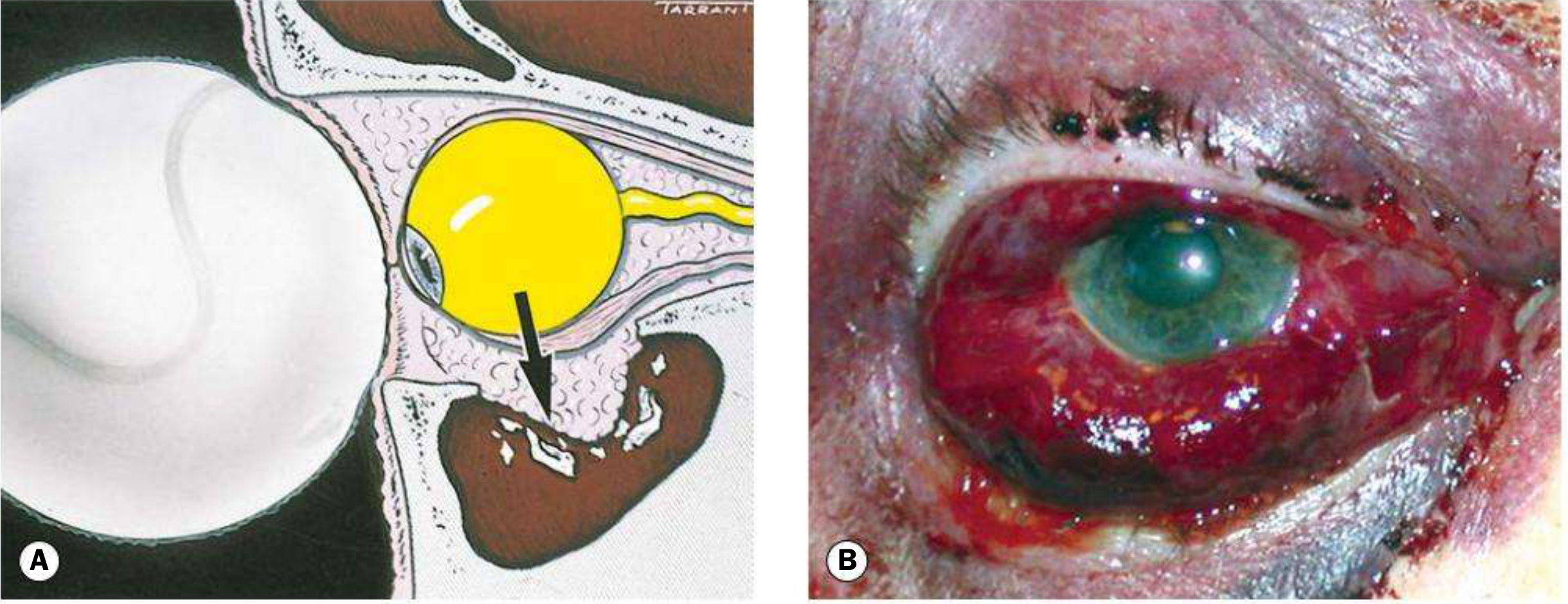 Blow-out fracture mechanism: Kanski's diagram showing globe displacement and orbital floor fracture into maxillary sinus, with clinical photo of periocular ecchymosis