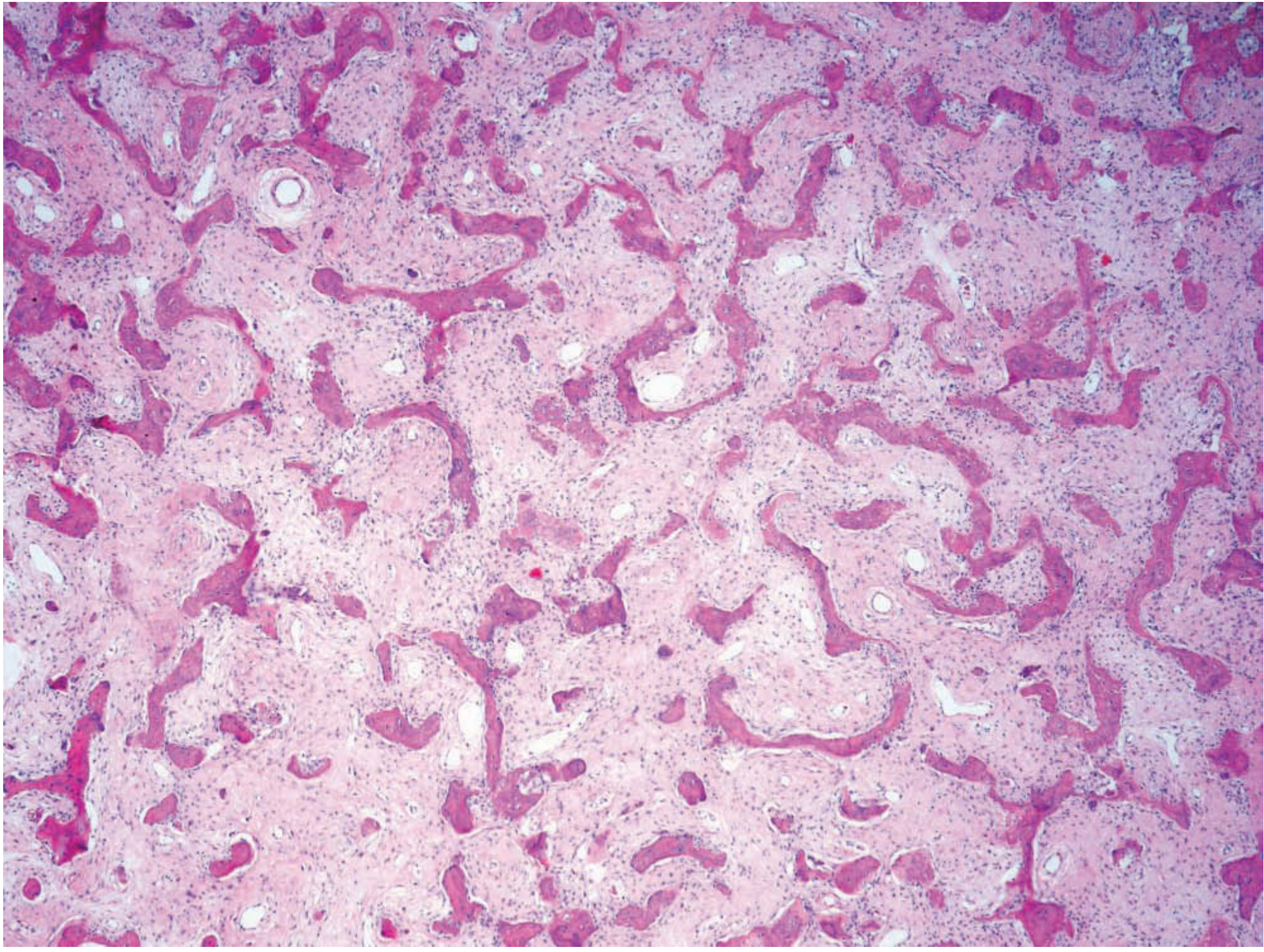 Fibrous dysplasia histopathology - Chinese character trabeculae