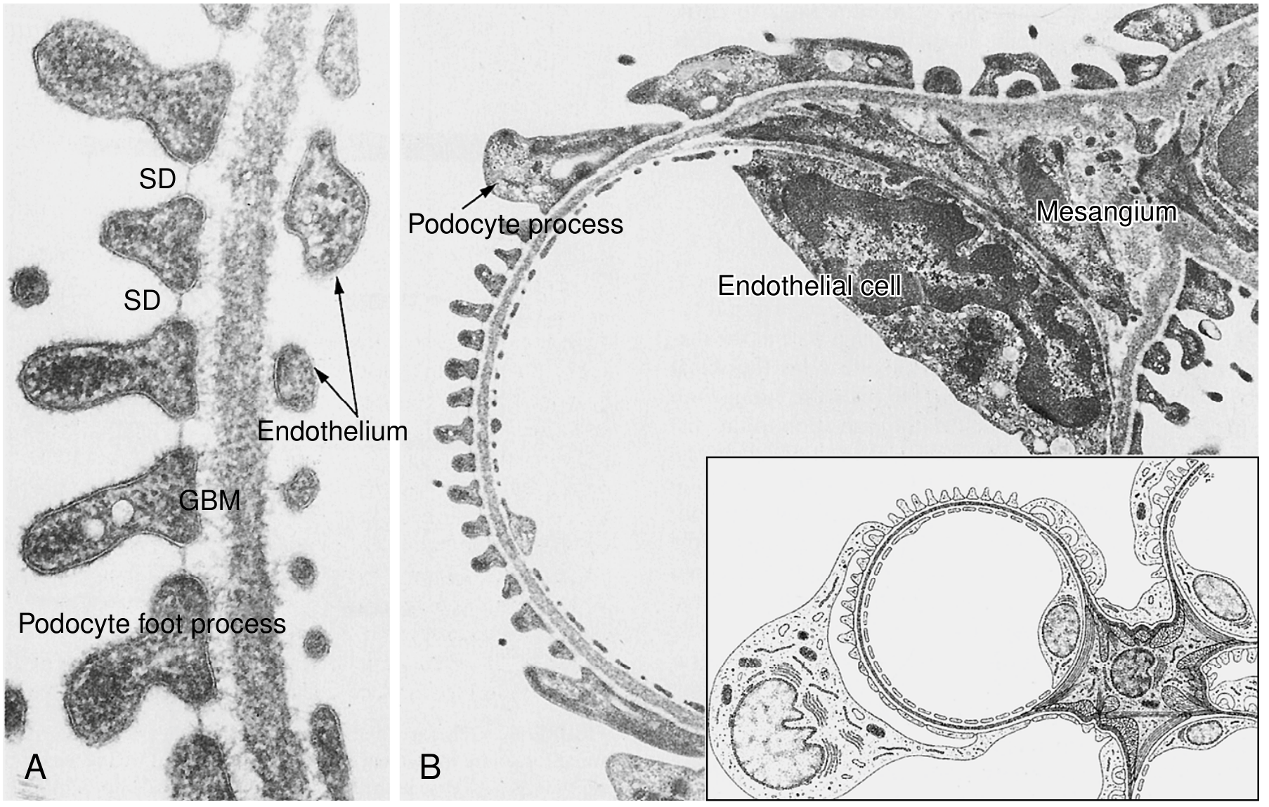 Filtration barrier EM: podocyte foot processes (SD = slit diaphragm), GBM, and fenestrated endothelium clearly labeled