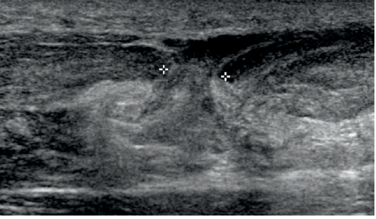 Complete Achilles Tendon Rupture - sagittal ultrasound showing 8mm gap between torn tendon ends marked by crosshairs
