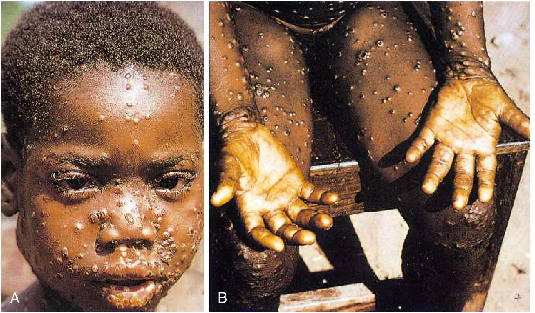 Monkeypox rash on face (A) and extremities/palms (B) in a 7-year-old girl, Central Zaire