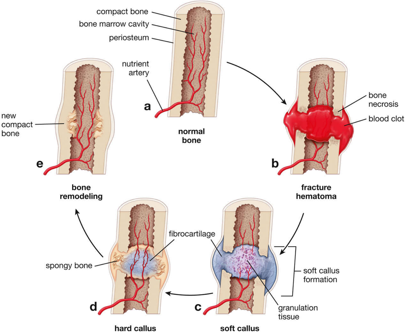 Stages of bone fracture healing showing hematoma → soft callus → hard callus → remodeling