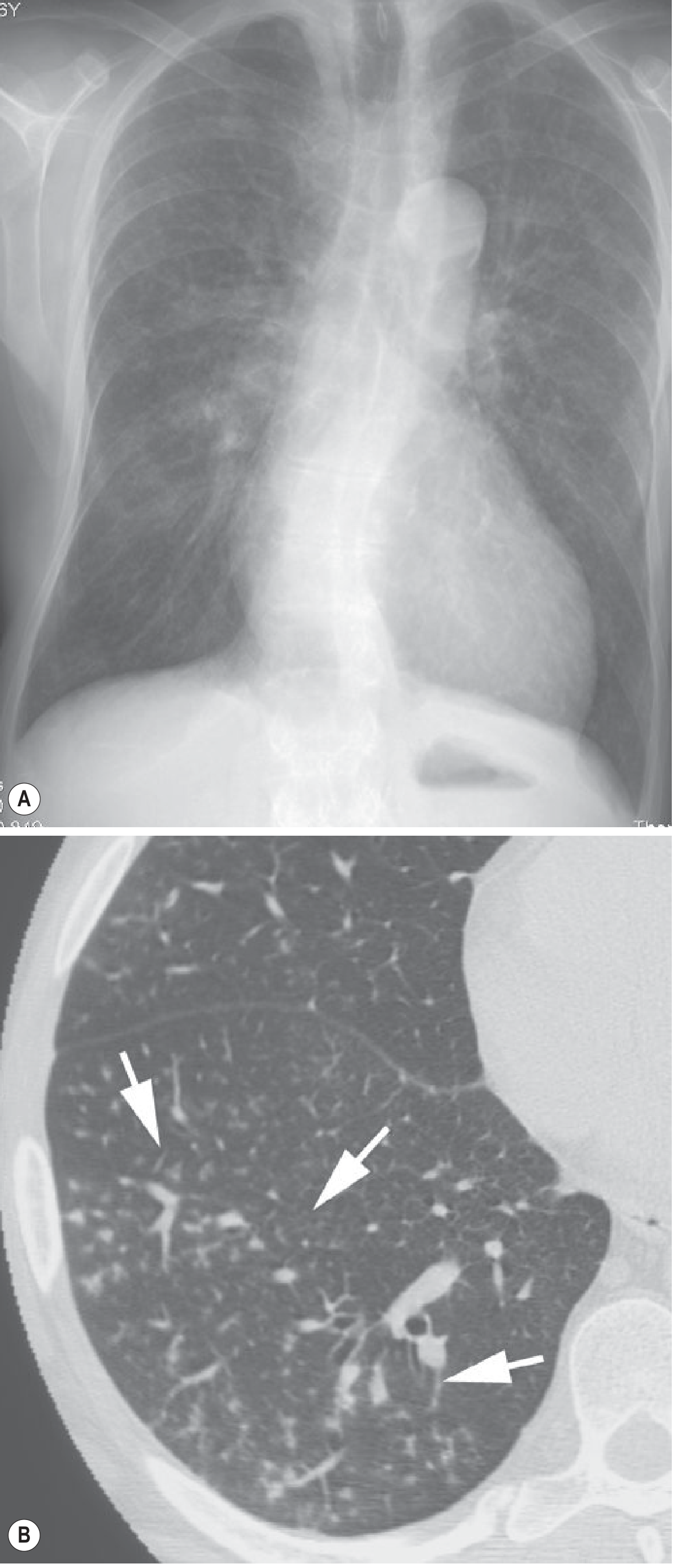 Normal CXR vs CT tree-in-bud in Mycoplasma bronchiolitis