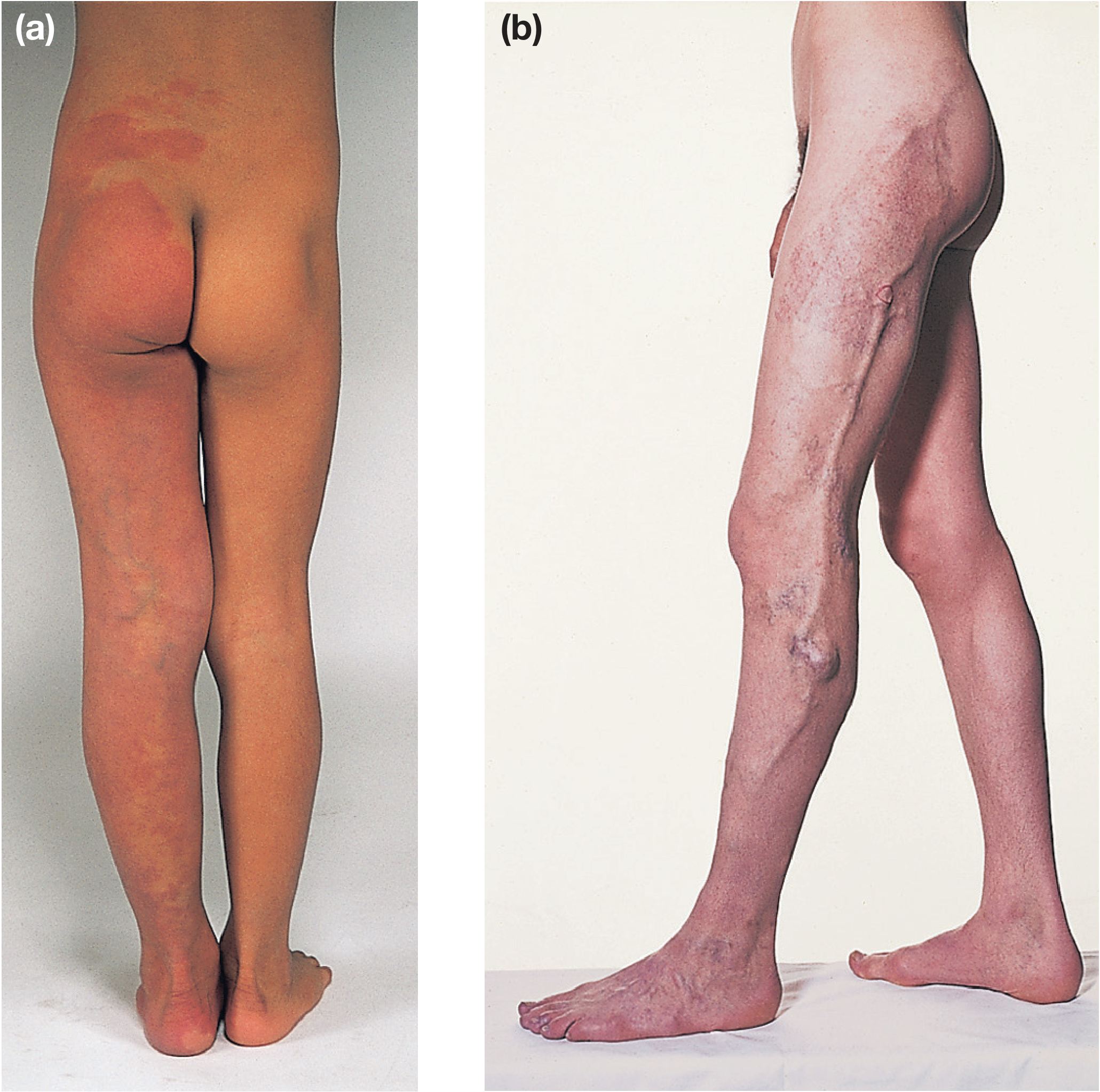 Two patients with Klippel-Trénaunay syndrome showing capillary naevus and varicose veins