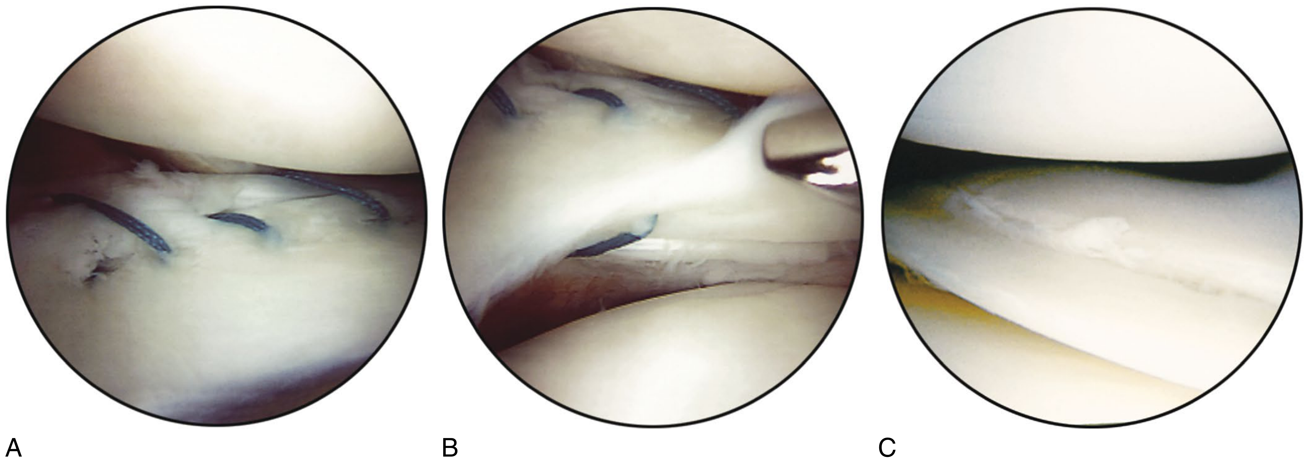 Arthroscopic views: A) unstable peripheral tear being repaired with vertical mattress sutures, B) incomplete undersurface tear amenable to abrasion + sutures, C) avascular zone tear generally treated with excision