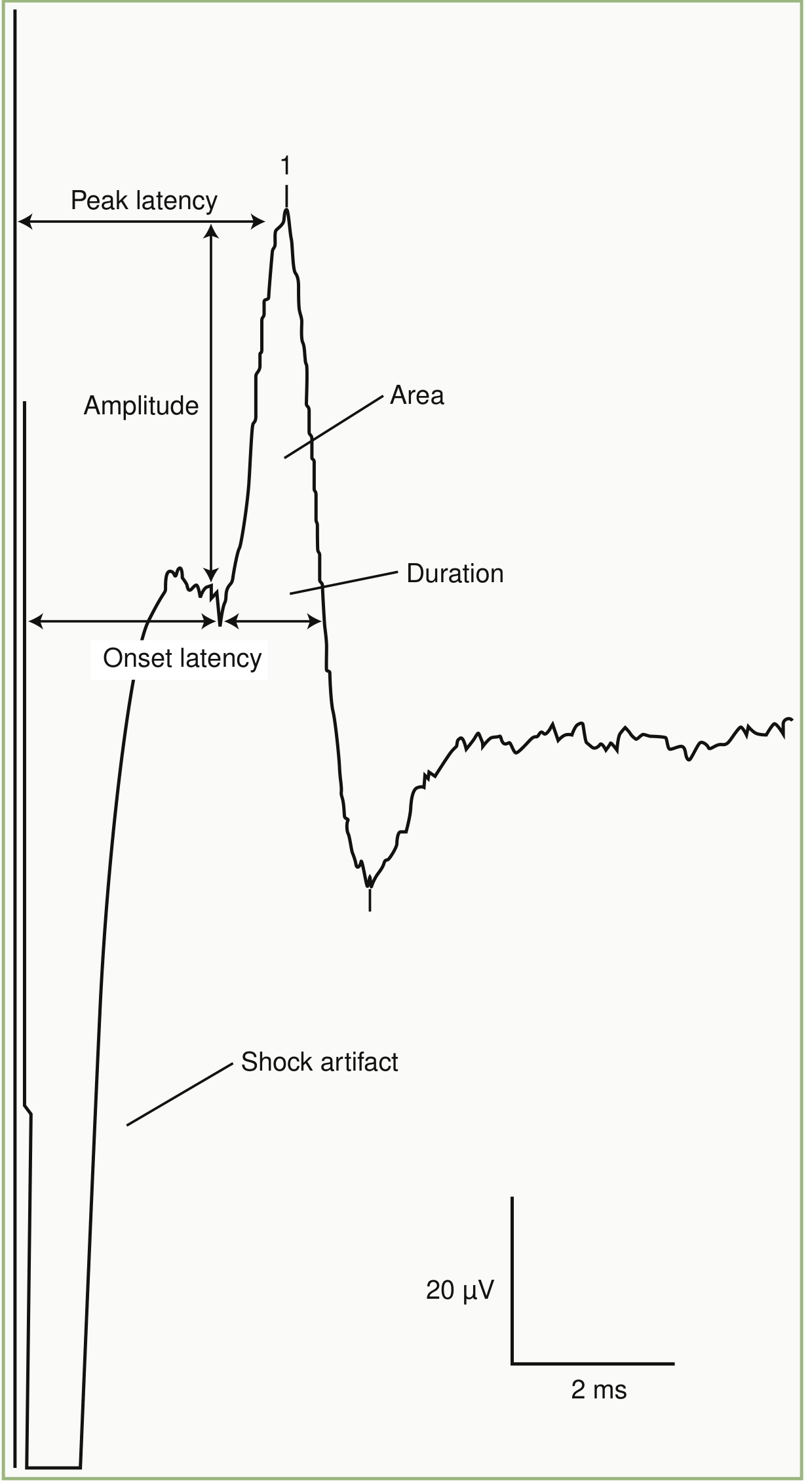 Antidromic median SNAP showing onset latency, peak latency, amplitude, duration, and area. Scale: 20 µV / 2 ms