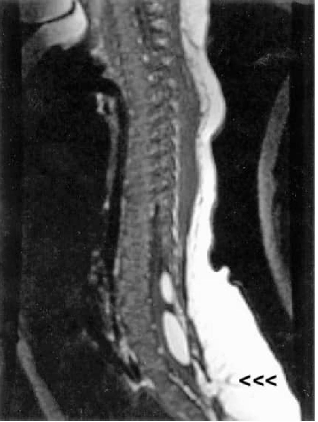 Sagittal T1-weighted MRI showing spina bifida with protruding lipomyelomeningocele (arrowheads), low-lying conus medullaris, and lipomas of the filum terminale
