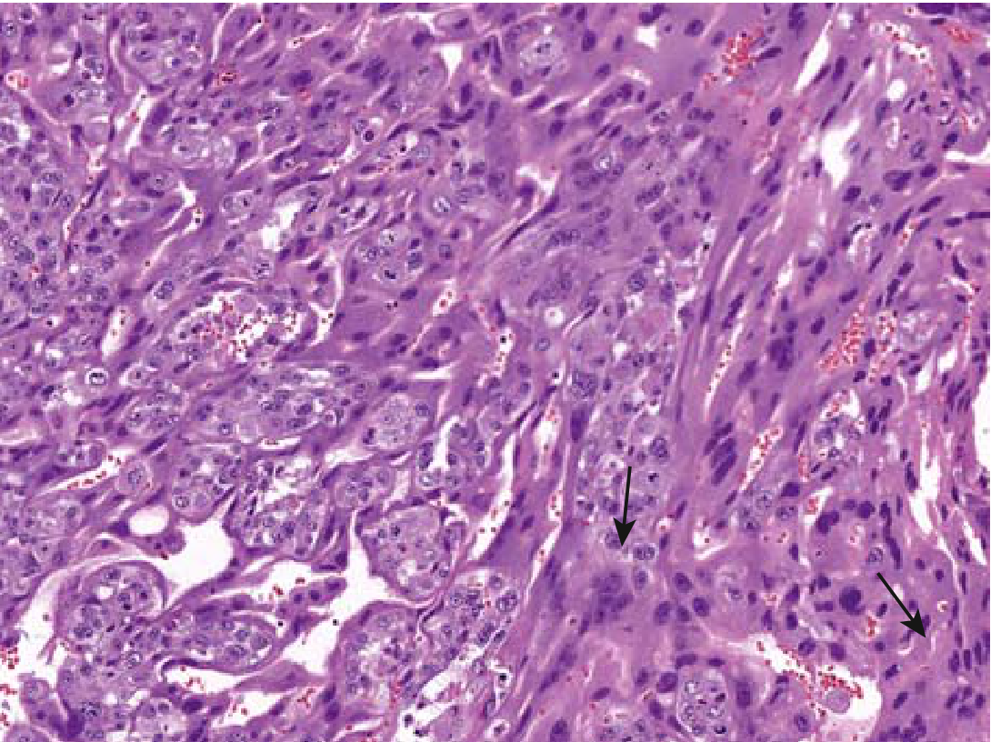 Choriocarcinoma histology: neoplastic cytotrophoblasts (left) and multinucleate syncytiotrophoblasts (arrows, right)