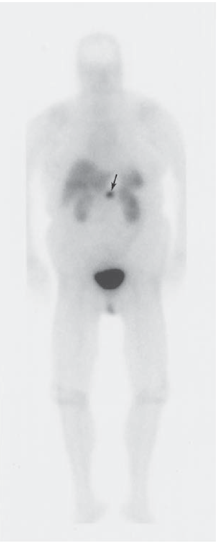 Radioactive octreotide scan showing pancreatic endocrine tumor in the body of the pancreas