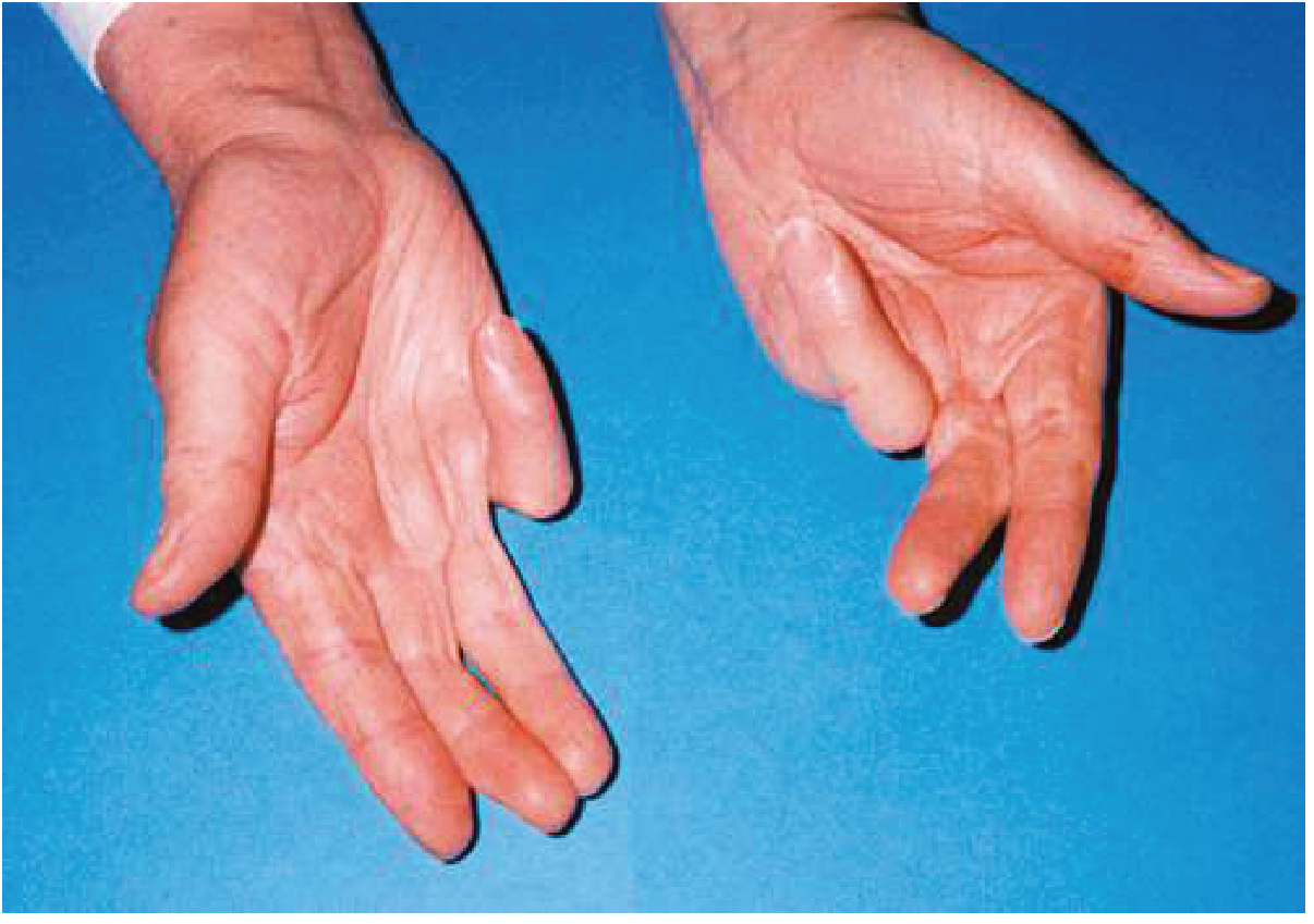 Dupuytren's contracture - bilateral palmar fascia thickening causing fixed finger flexion