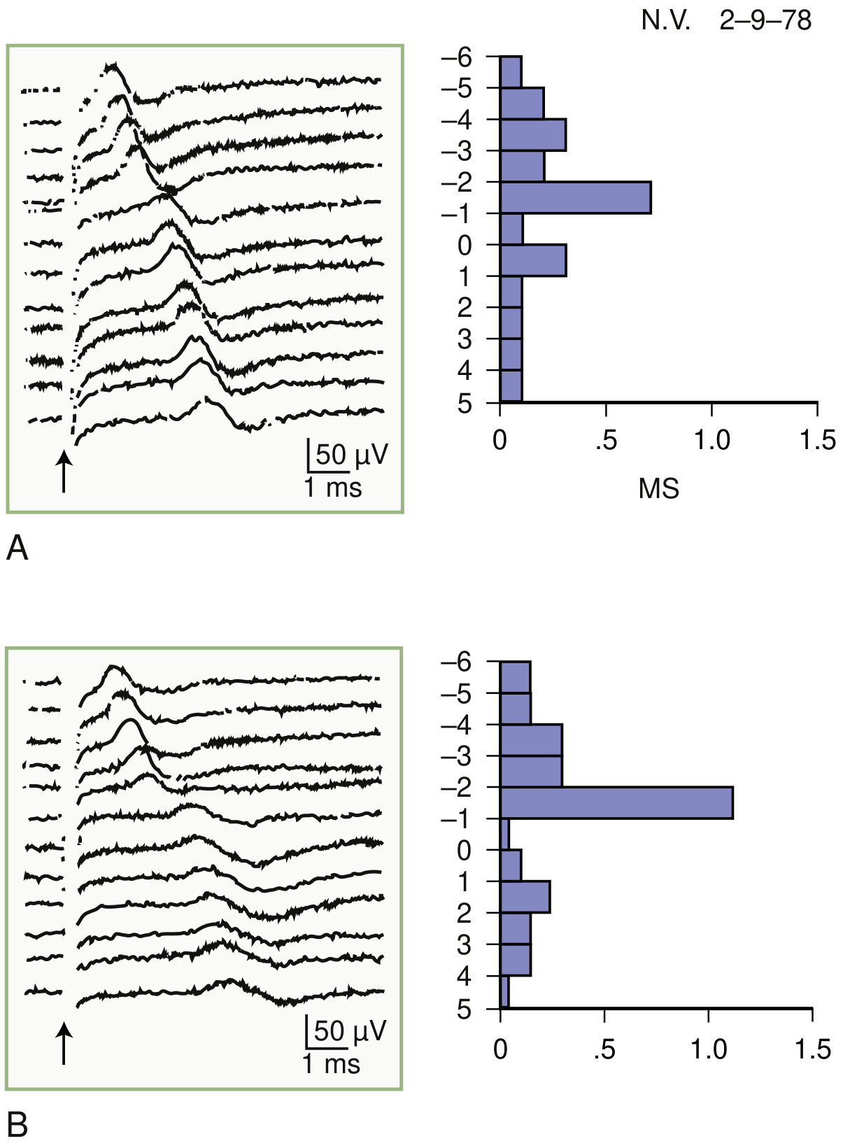 Left panel: Normal subject - SNAP latencies increase linearly (~0.16-0.21 ms/cm). Right panel: CTS patient - abrupt latency jump and waveform change at the site of compression