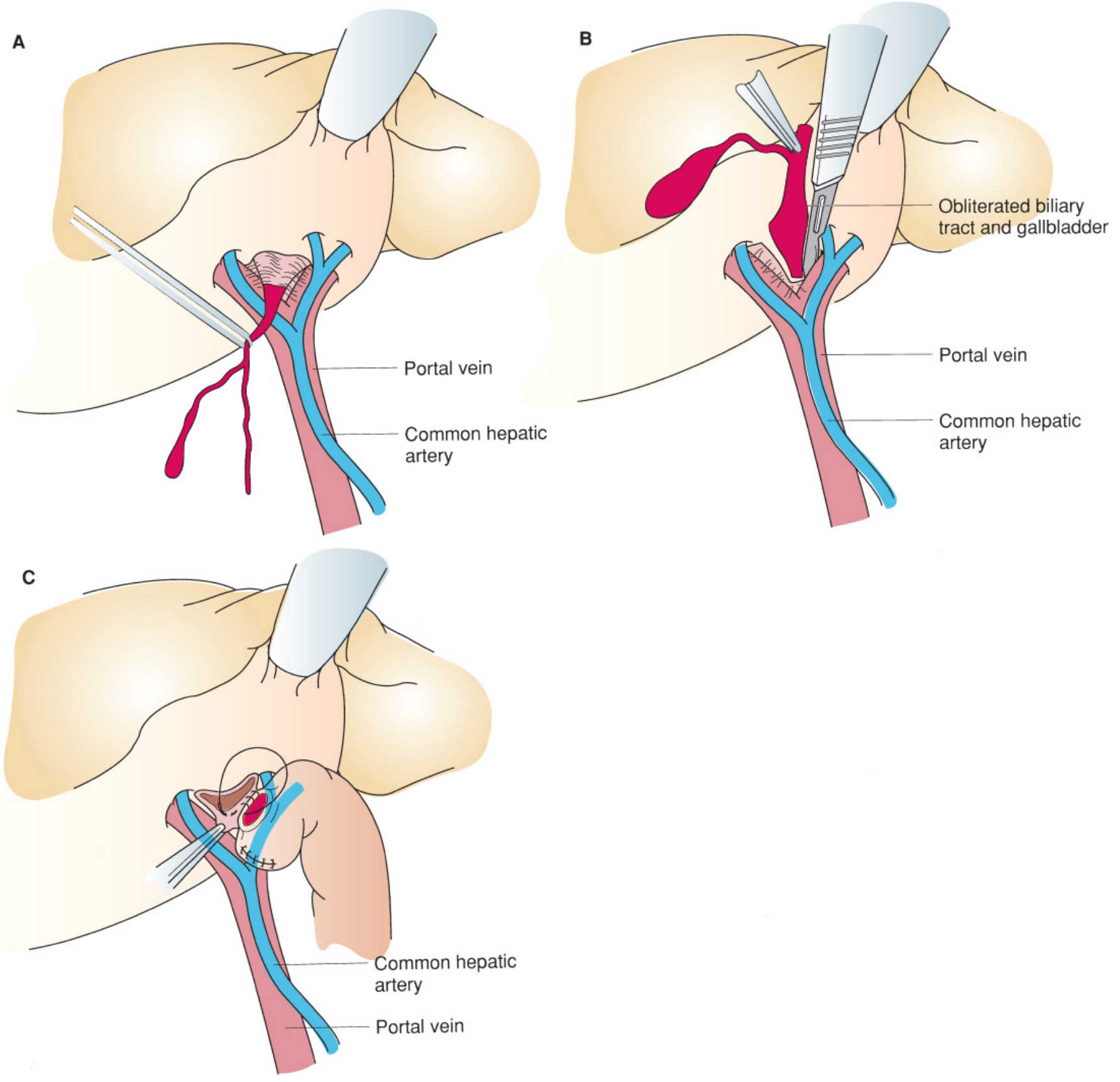 Kasai portoenterostomy steps