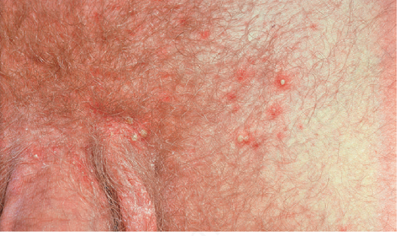 Staphylococcal folliculitis of the pubic/groin area