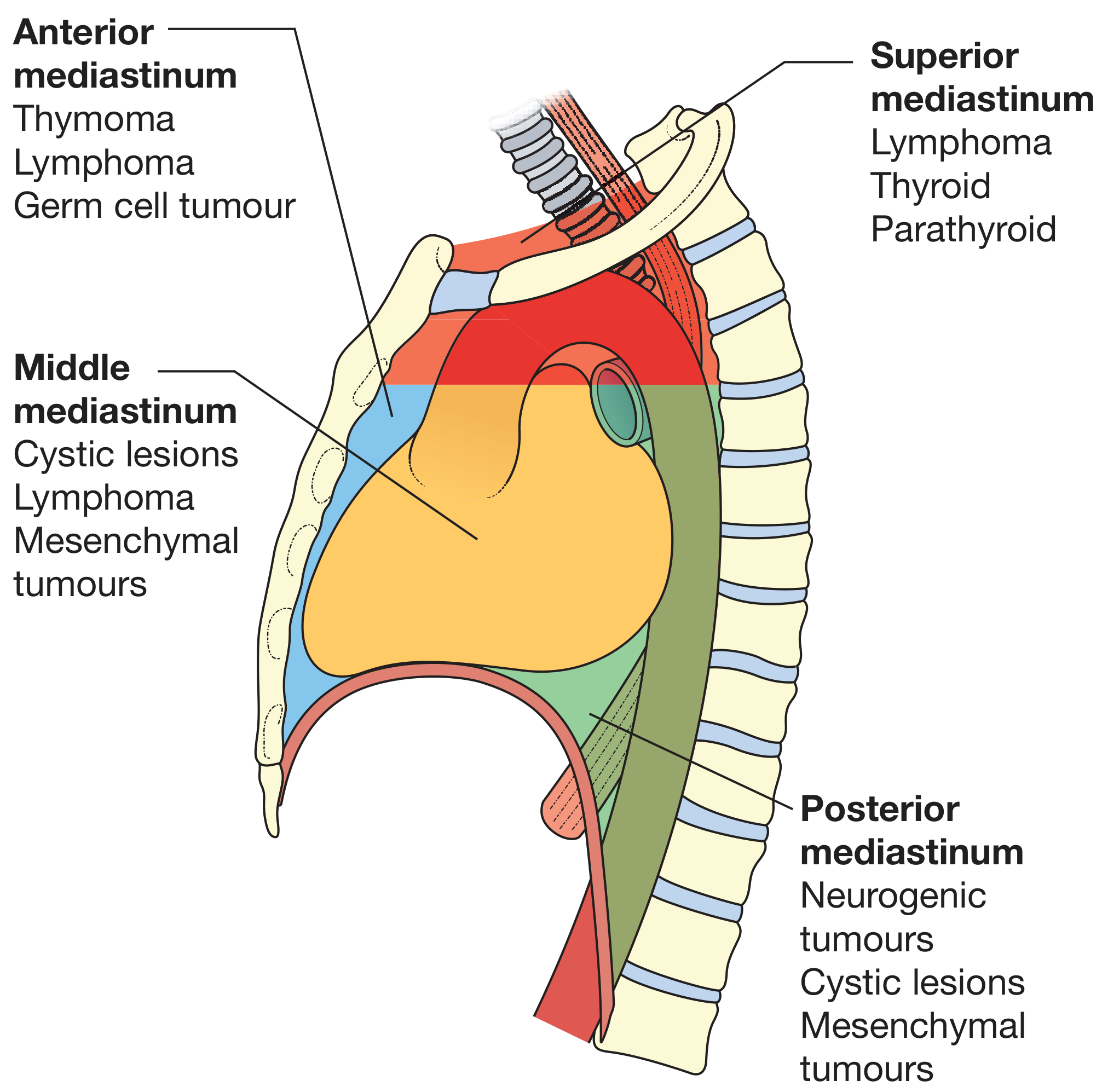 Mediastinal subdivisions with associated pathological tumors for each compartment