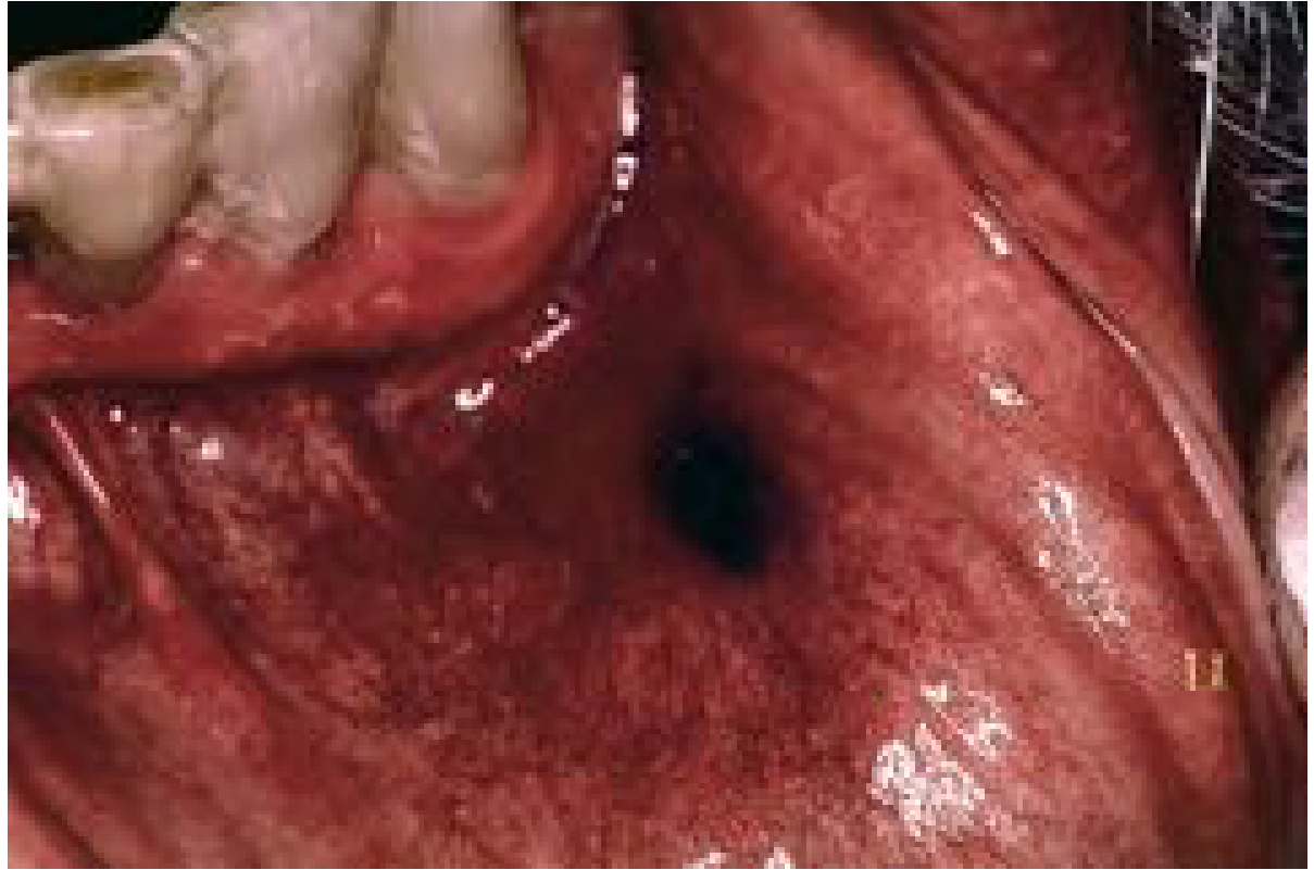 Amalgam tattoo - grey-black macular lesion on labial mucosa