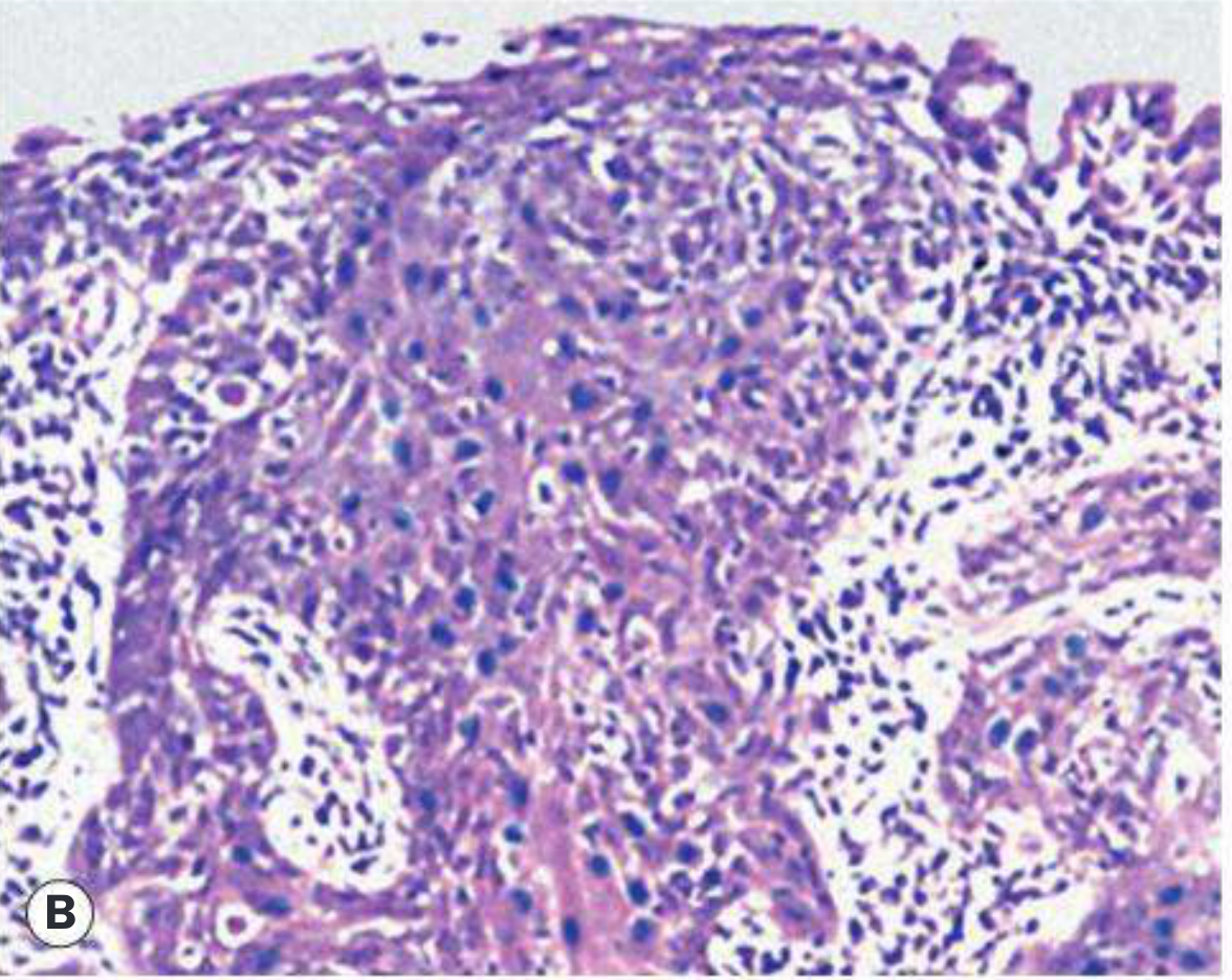 OSSN histology - invasive SCC showing stromal infiltration