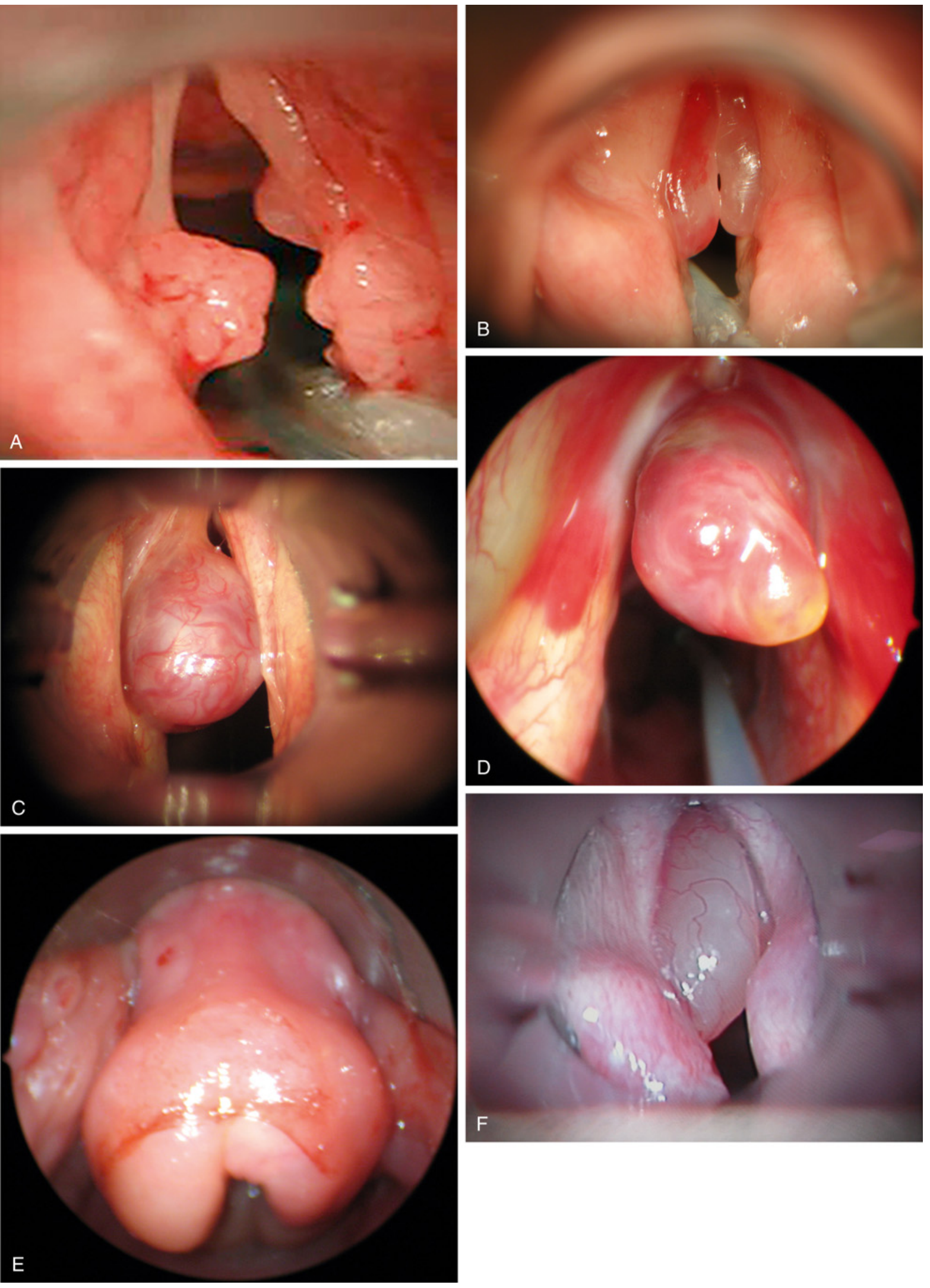 Vocal cord lesions - papilloma, Reinke edema, polyp, granuloma, epiglottic edema, cyst