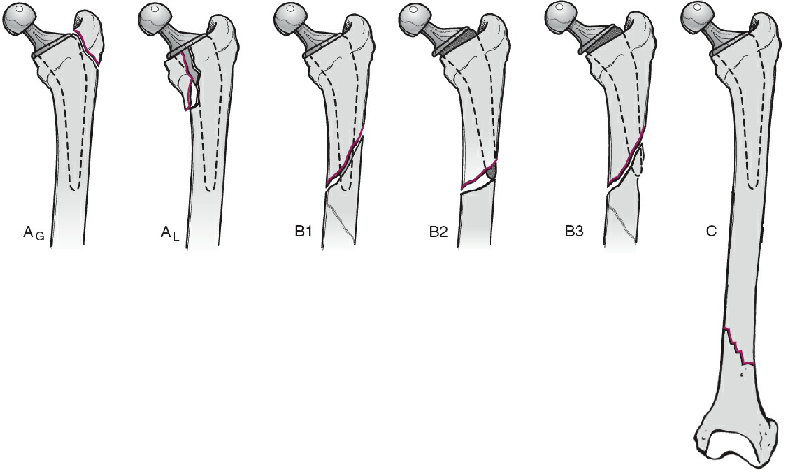 Vancouver Classification Diagram