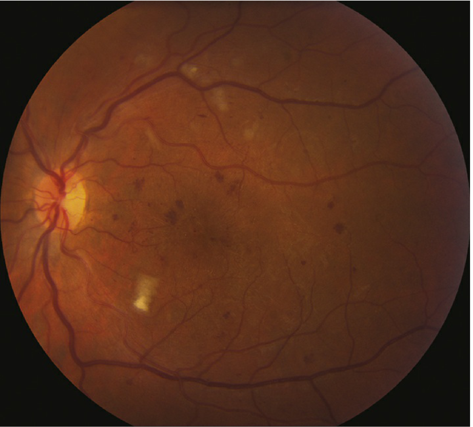 Moderate NPDR with microaneurysms and cotton-wool spots - Wills Eye Manual