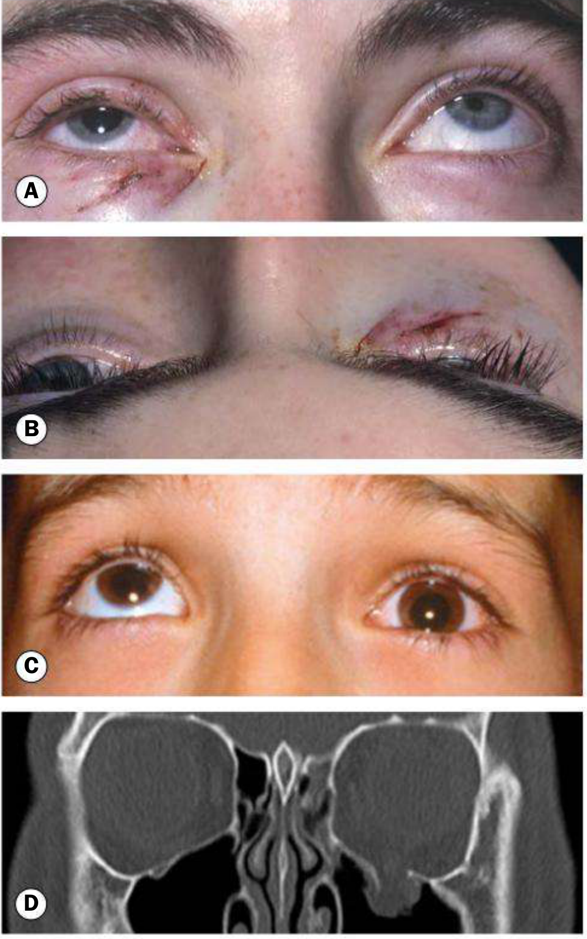 Clinical features: (A) Restricted upgaze right eye; (B) mild right enophthalmos; (C) white-eye blow-out in a child; (D) coronal CT showing inferior rectus entrapment