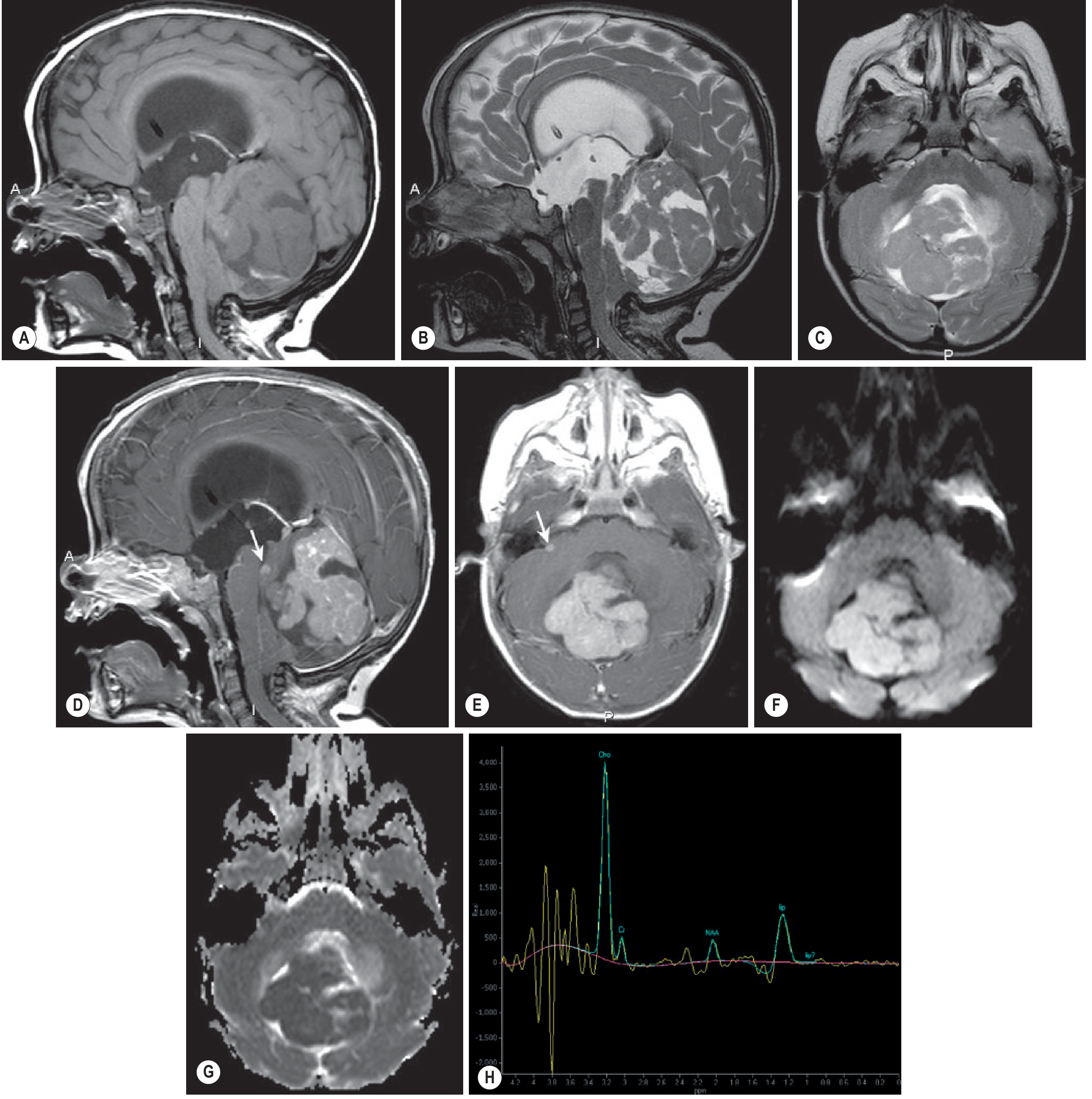 Medulloblastoma with extensive nodularity: A-C Sagittal T1, T2, axial T2 showing large cerebellar vermian mass; D-E Post-contrast nodular enhancement with secondary lesions in aqueduct; F-G Restricted diffusion on DWI/ADC; H MRS showing elevated choline, reduced NAA/creatine, lipid peak