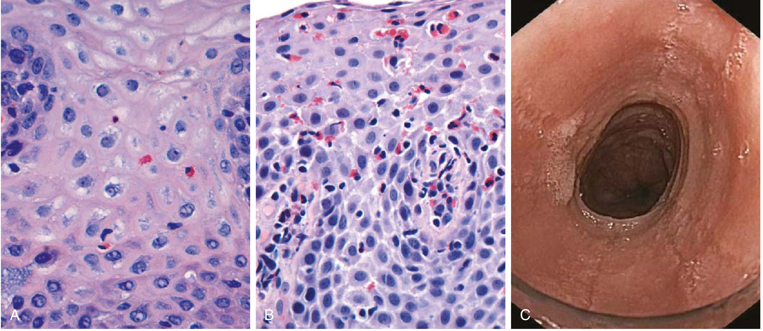 EoE histology and endoscopy: (A) Reflux esophagitis with scattered eosinophils; (B) EoE with numerous intraepithelial eosinophils and eosinophilic microabscesses; (C) Endoscopic view showing characteristic circumferential rings ("trachealization") of the proximal esophagus