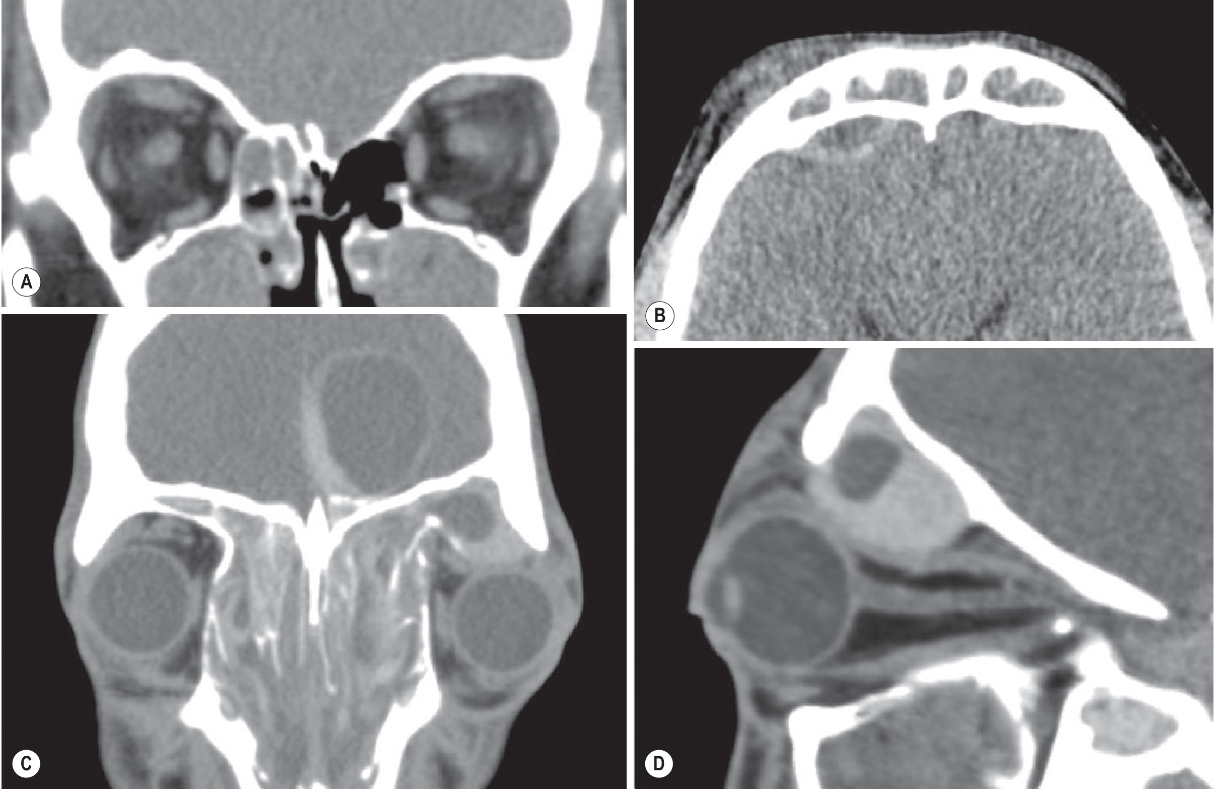Orbital cellulitis + empyema from sinusitis CT