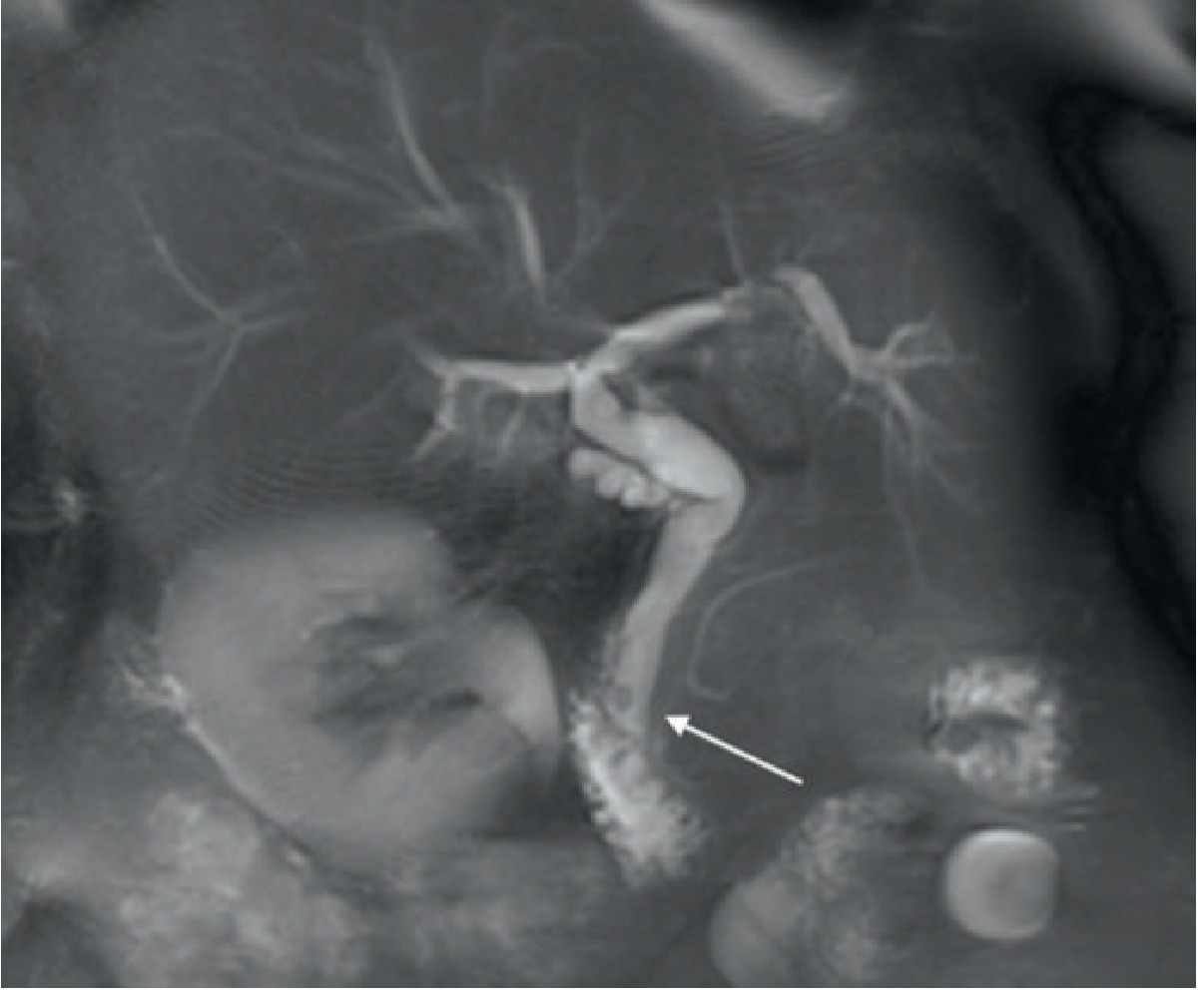 CBD Stone on MRCP