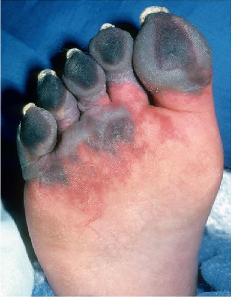 Angioedema - severe peripheral involvement with erythema and tissue swelling