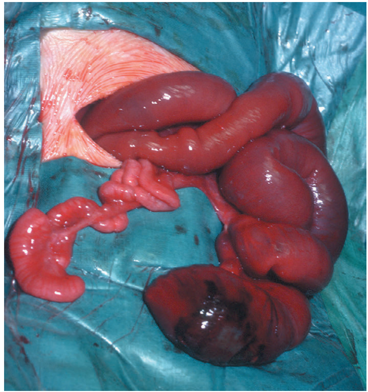 Apple-peel jejunal atresia - obstructed proximal jejunum with collapsed distal ileum coiled around remnant ileocolic artery