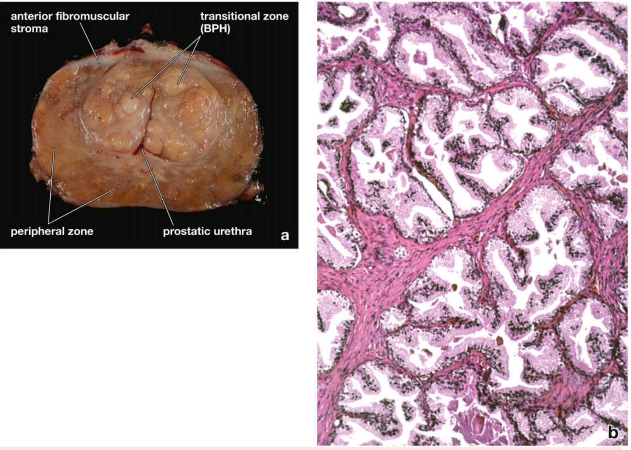 BPH cross-section and histology showing the enlarged transition zone with nodules compressing the prostatic urethra, alongside the peripheral zone. The micrograph shows characteristic folded epithelium and glandular hypertrophy.