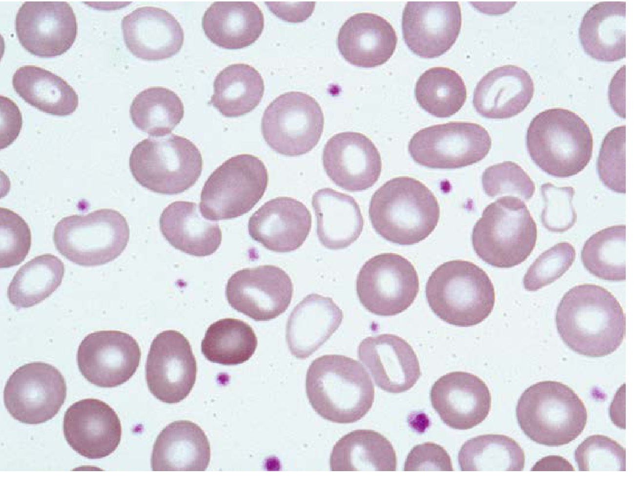 Dimorphic blood film - two populations: microcytic hypochromic cells mixed with normocytic normochromic cells