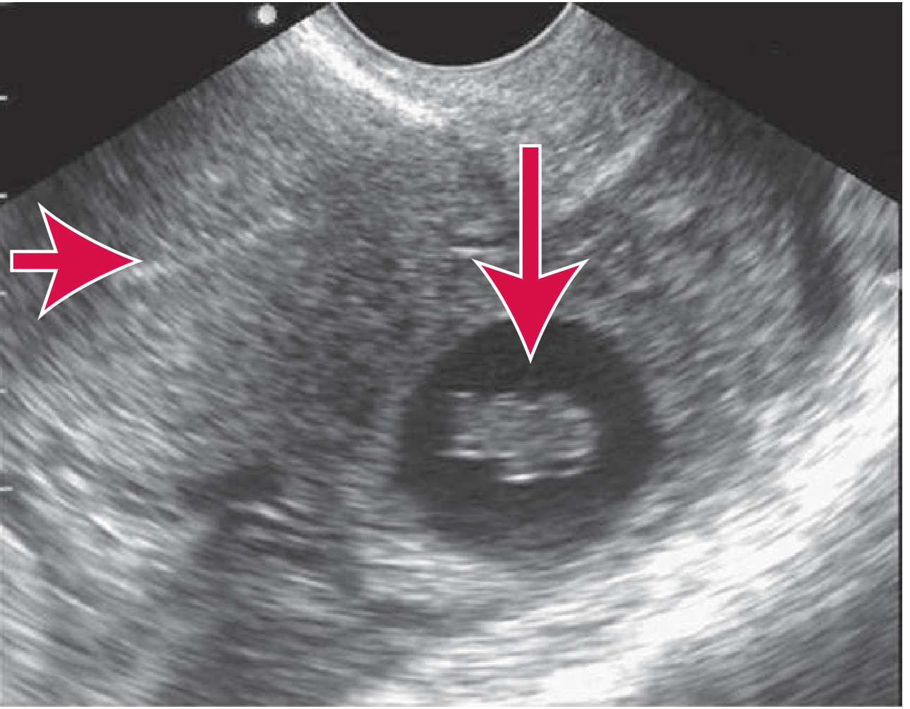 Living embryo in adnexa with empty uterus - ectopic pregnancy on TVS