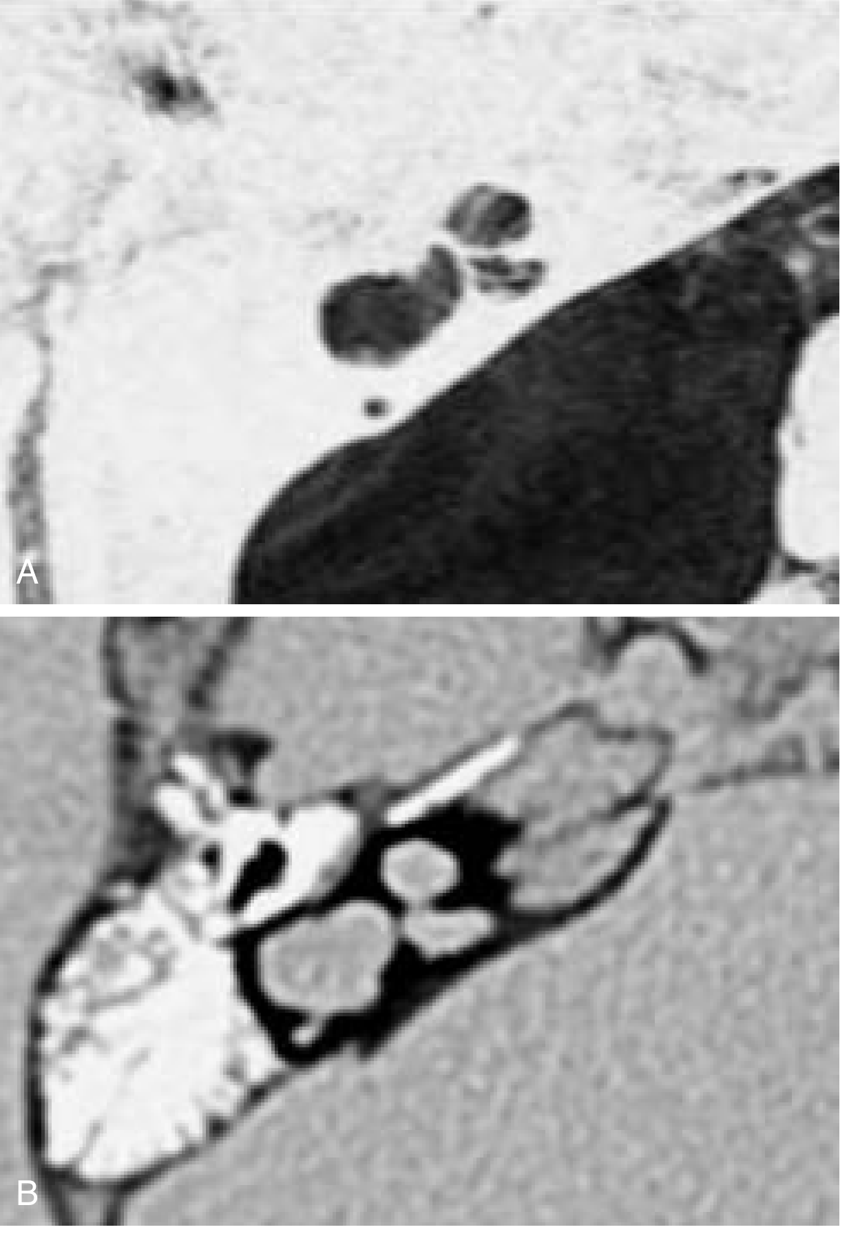 Incomplete partition (Mondini) - MRI (A) and CT (B) showing absence of interscalar septum