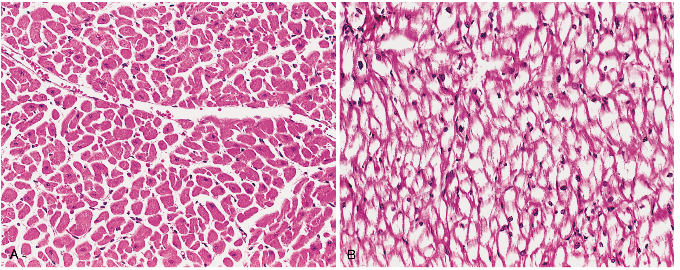 Pompe disease histology