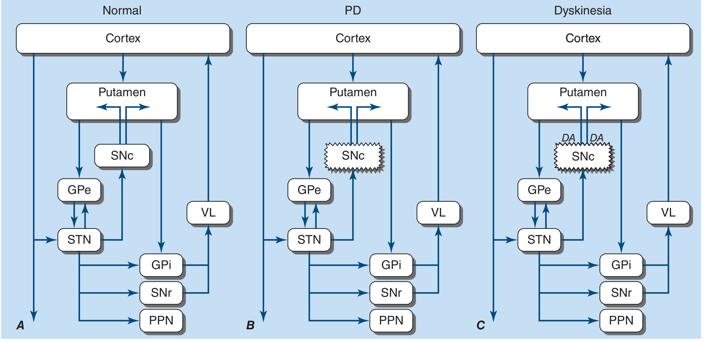 Basal ganglia in Normal (A) vs PD (B) vs Dyskinesia (C): In PD, SNc degenerates (jagged box), reducing dopaminergic input to putamen. Both direct and indirect pathways shift to increase GPi/SNr output, which excessively inhibits thalamus and VL, reducing cortical motor activation - causing hypokinesia