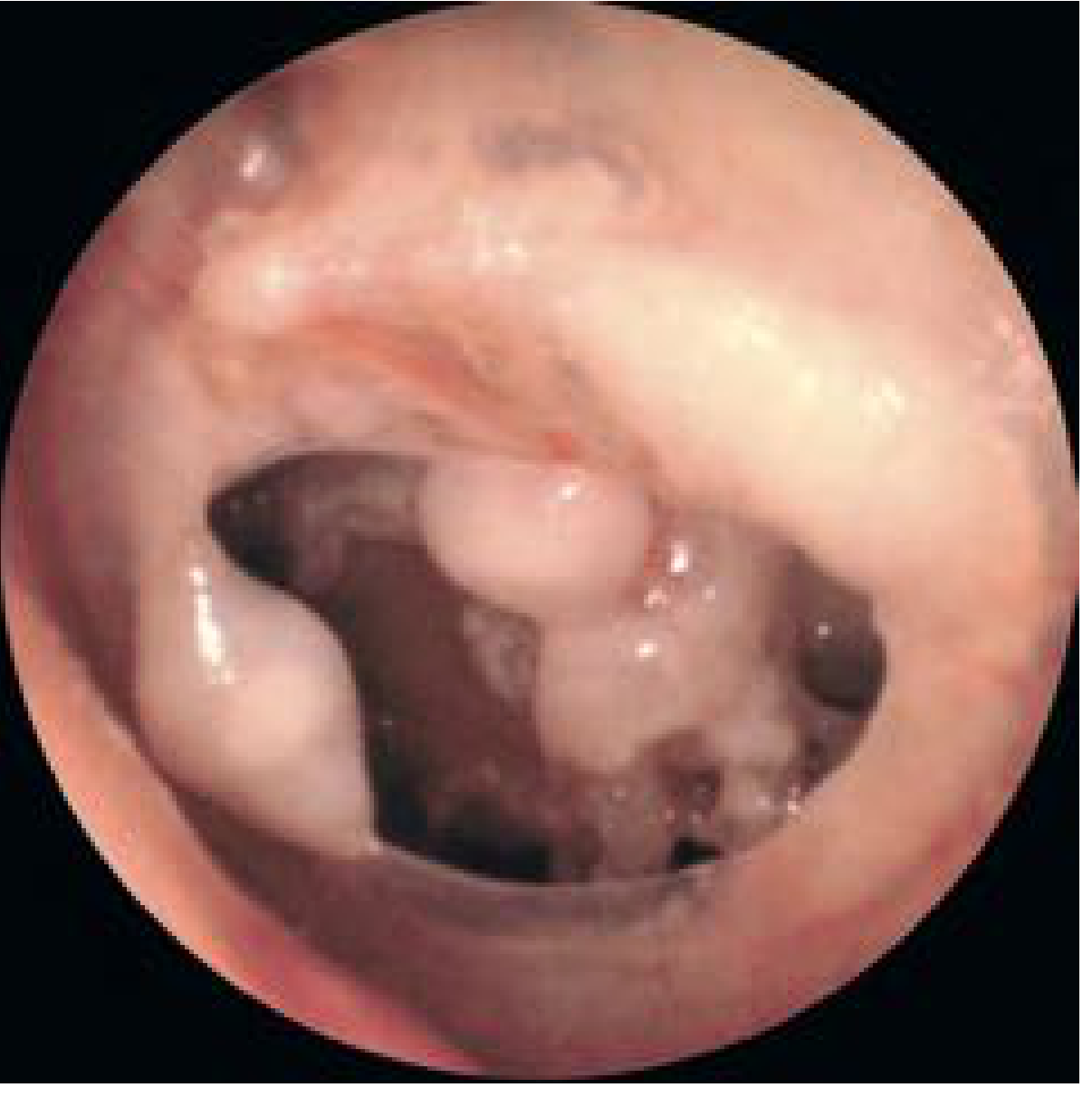 Advanced tympanosclerosis - white lesions on the promontory and malleus