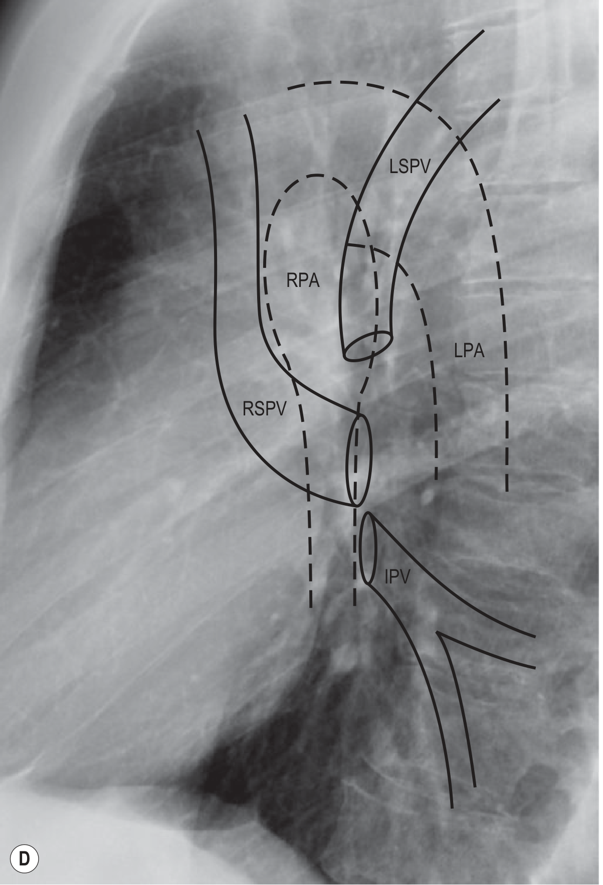 Normal Hilar Anatomy Diagram on Lateral CXR - Grainger & Allison's
