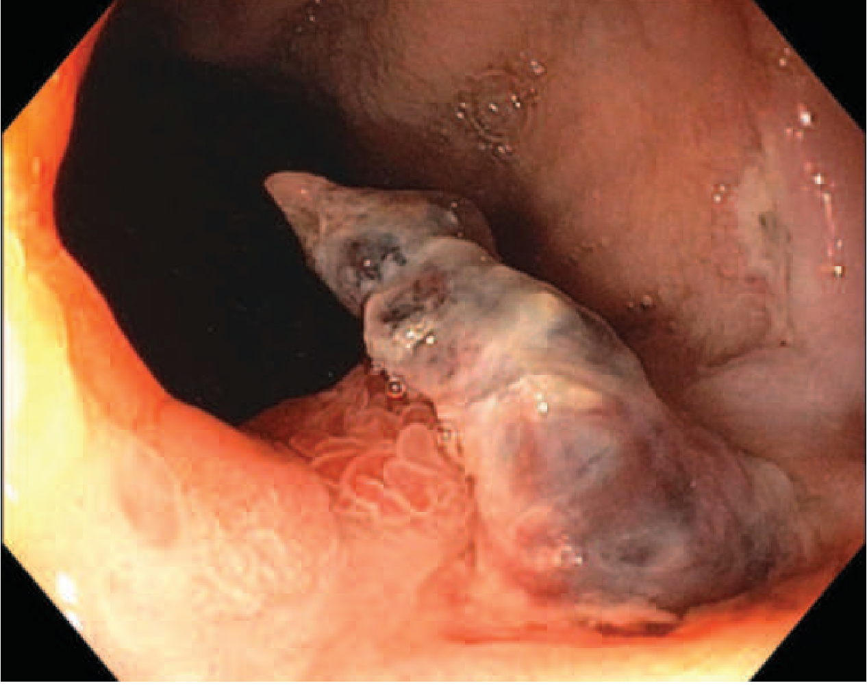 Mallory-Weiss tear with adherent clot at the GEJ - Harrison's Fig. 333-40