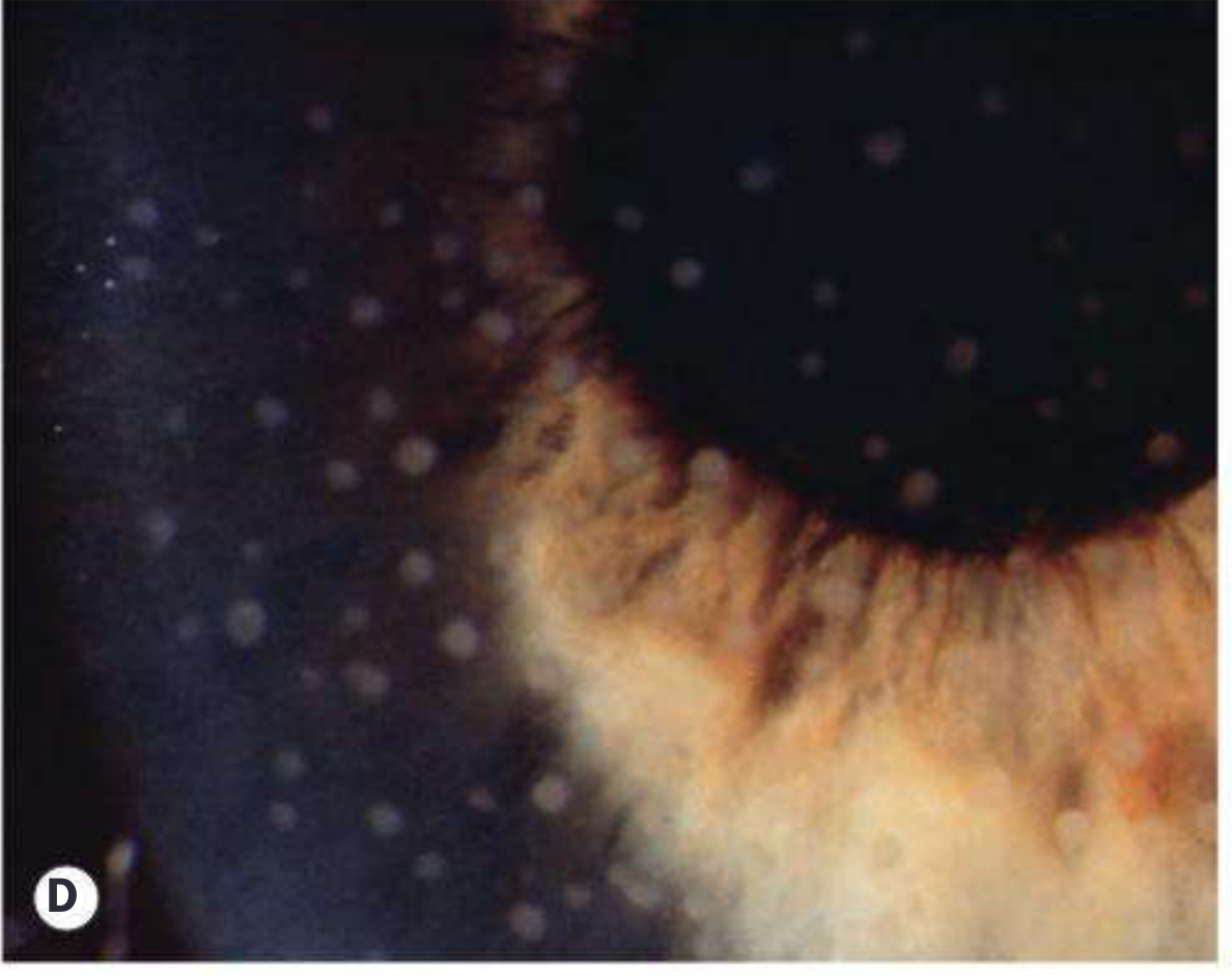 Posterior synechiae with small white KPs