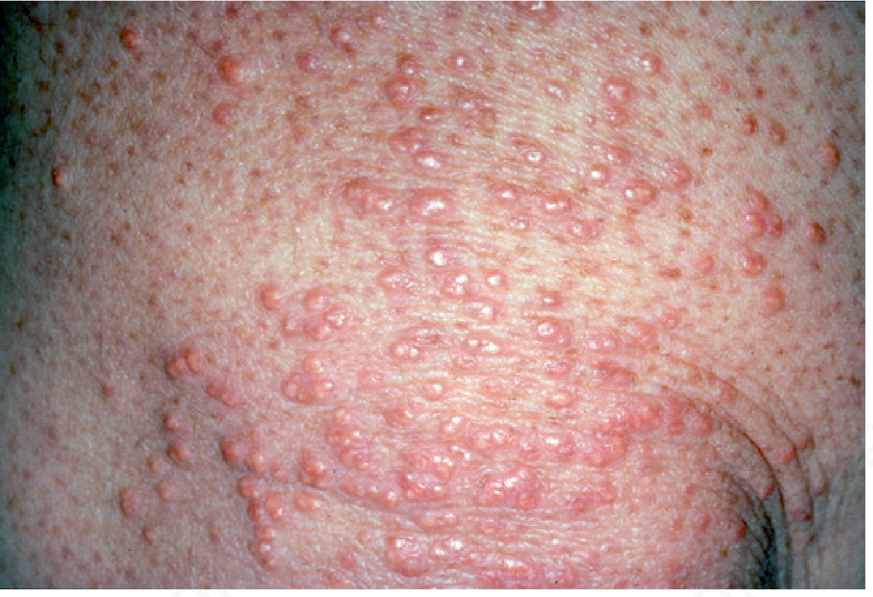 Eruptive xanthomas - crops of raised red-yellow papules on skin