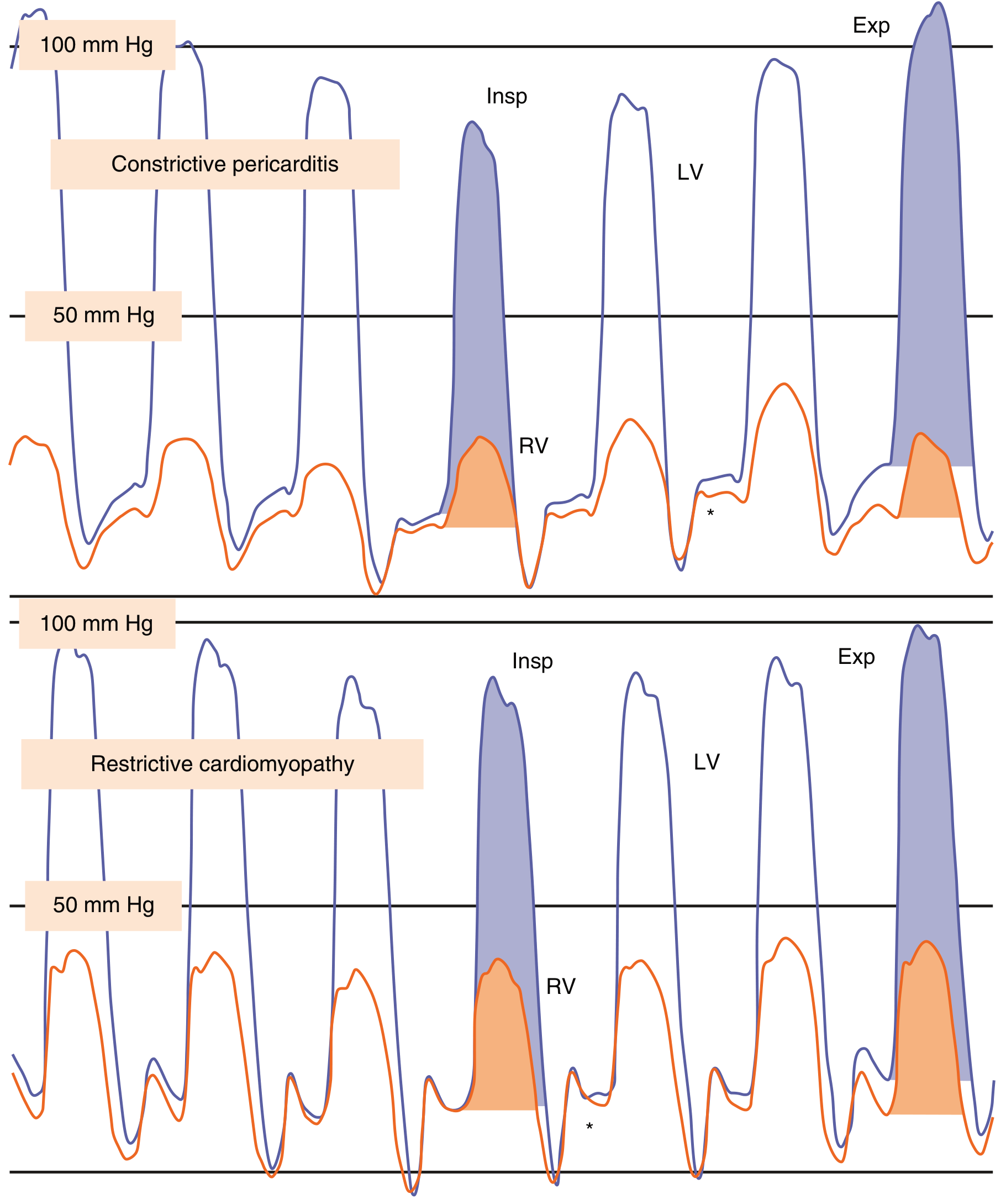 RCM vs CP hemodynamics - simultaneous LV/RV pressure tracings showing parallel (RCM) vs. discordant (CP) pressure changes