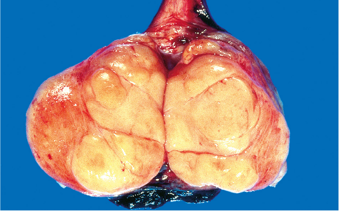 Seminoma of the testis - well-circumscribed, pale, fleshy, homogeneous mass on cut surface