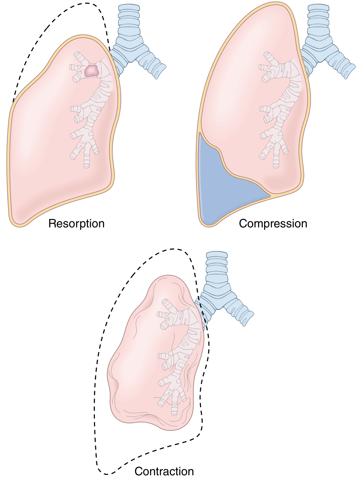 Three forms of acquired atelectasis: resorption (airway obstruction), compression (fluid/air in pleural space), and contraction (fibrosis preventing lung expansion)
